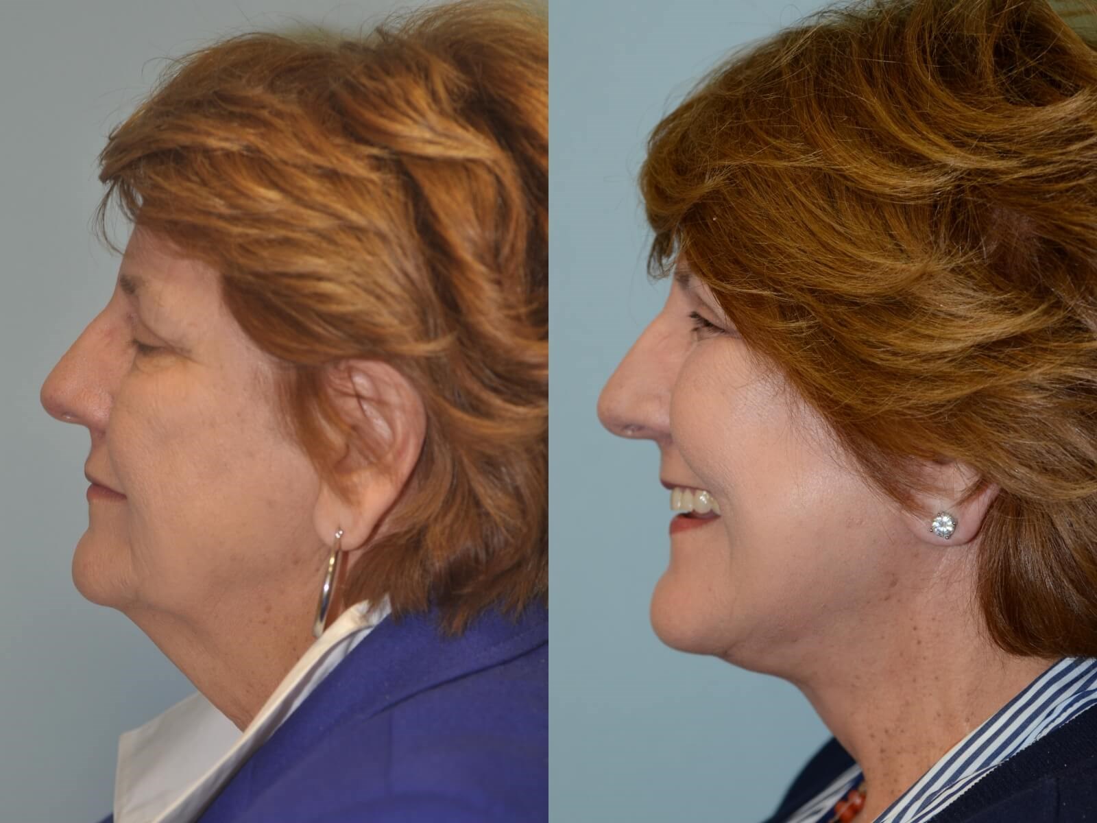 Smooth defined jawline Before and After