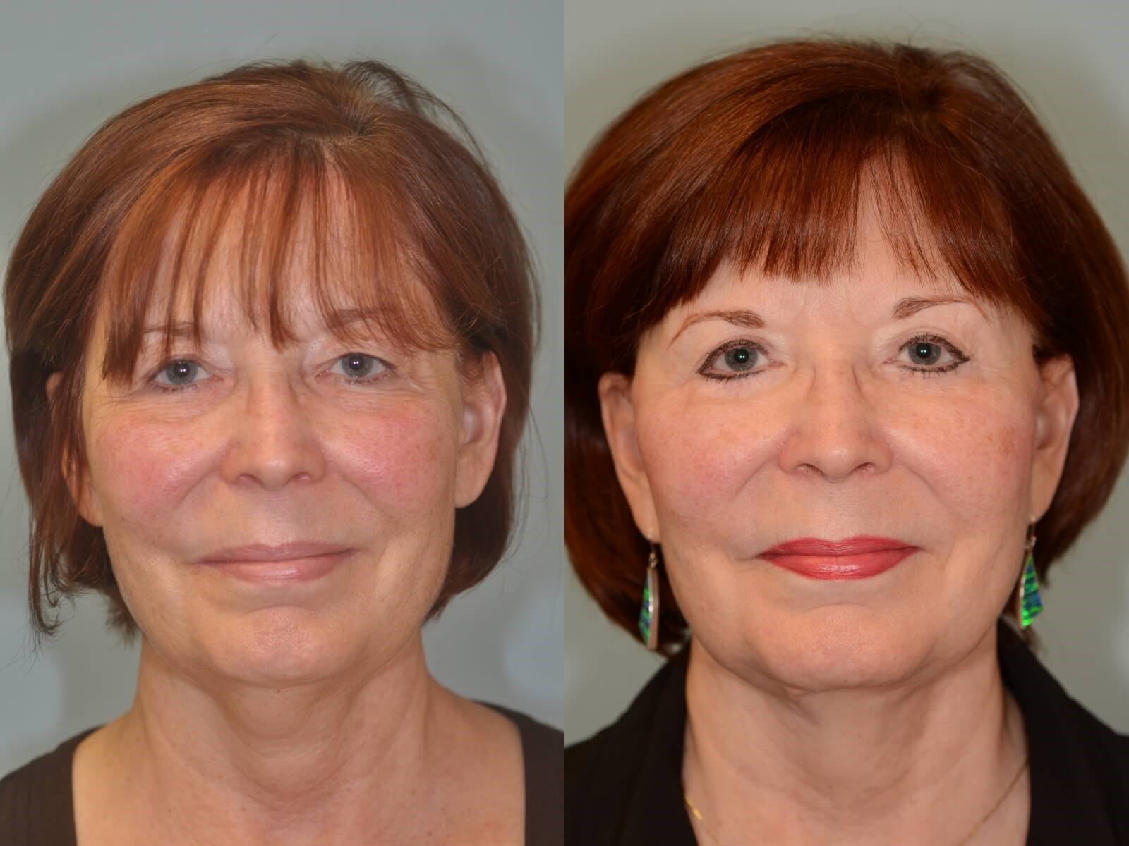 A more youthful appearance Before and After