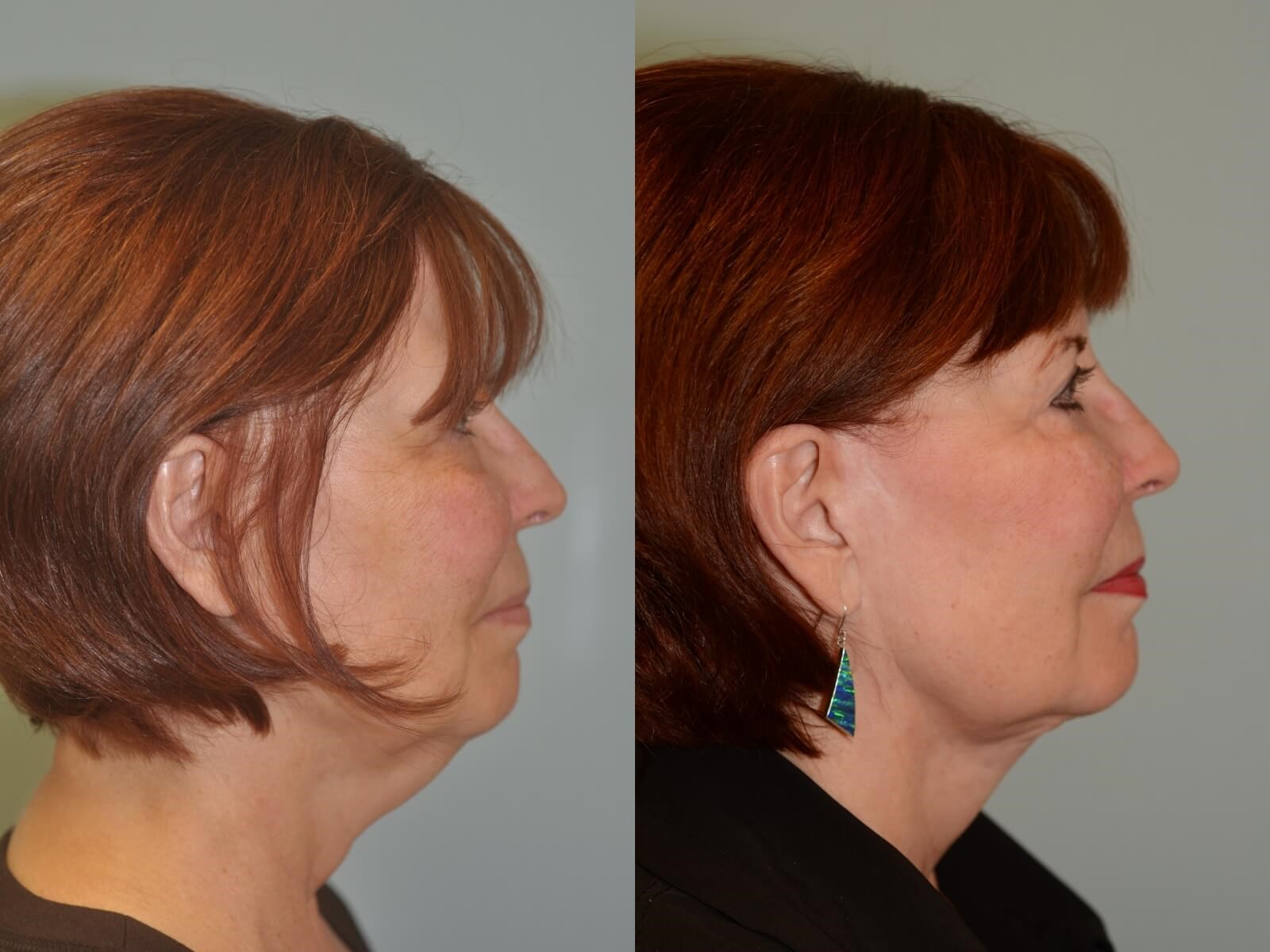 A slimmer side profile Before and After