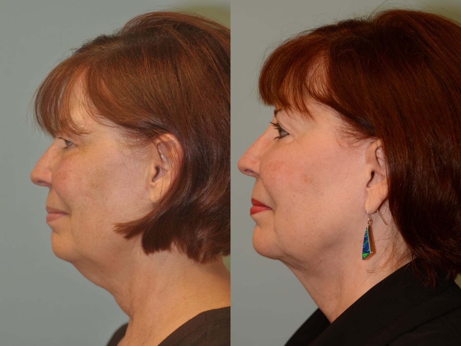 A slimmer side profile Before and After