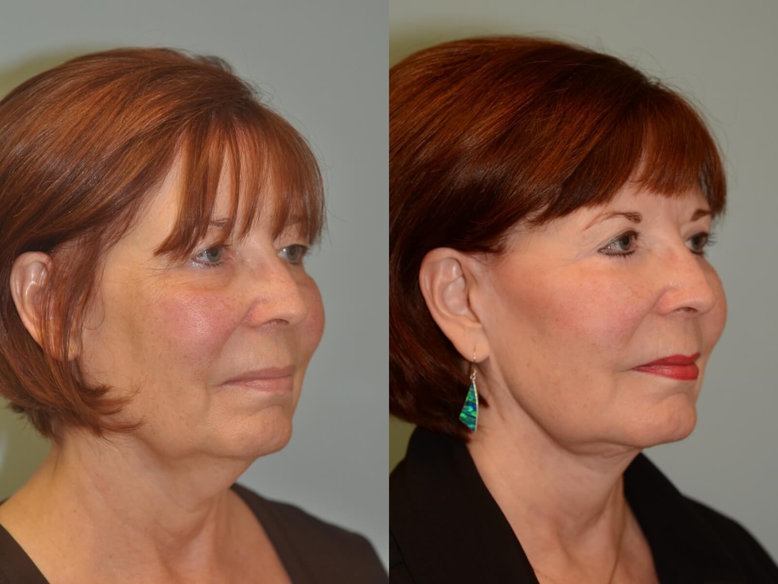 More defined cheekbones Before and After