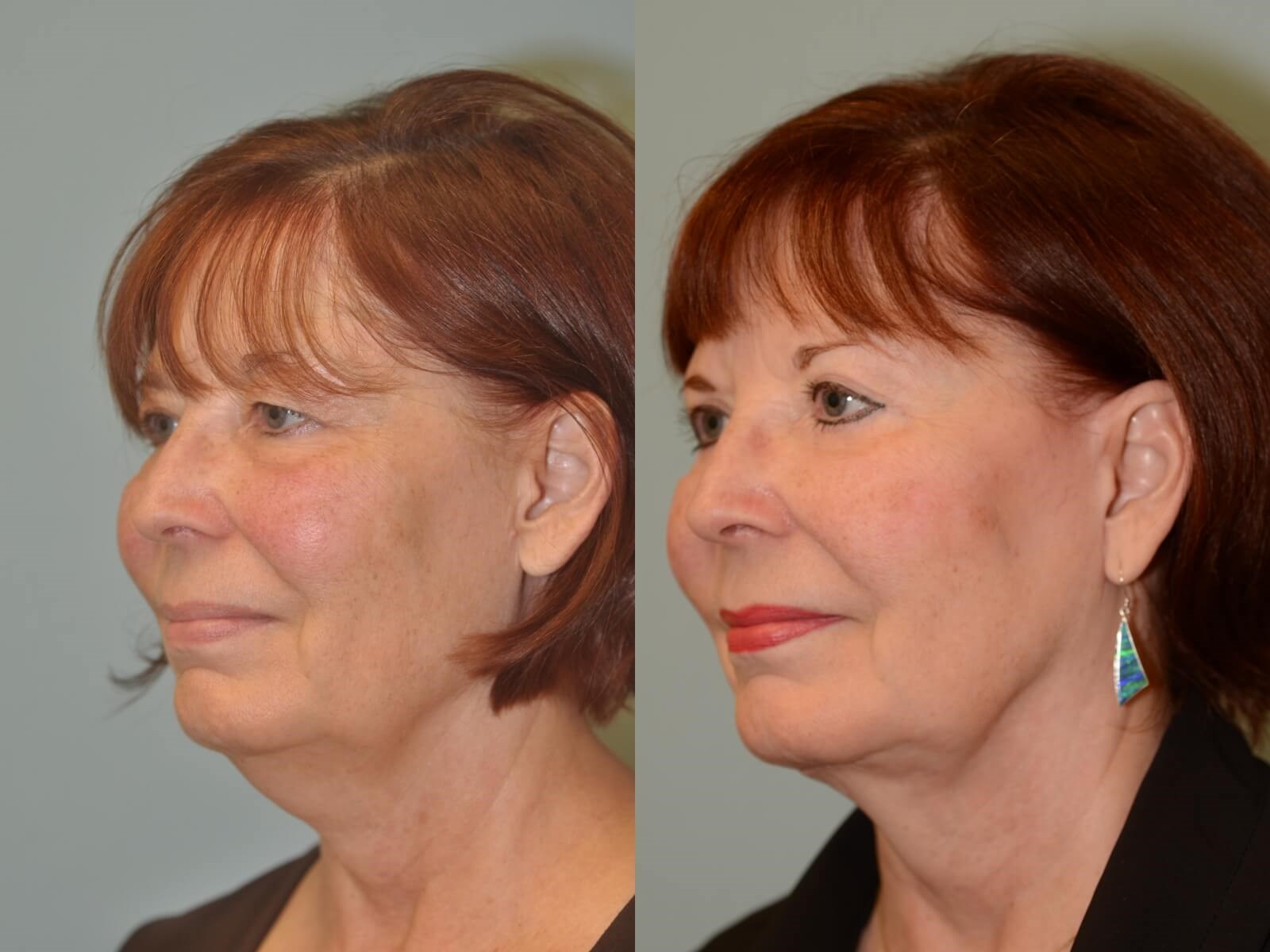 More defined cheekbones Before and After