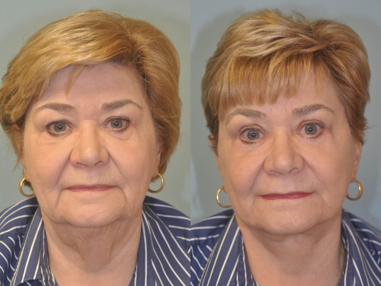 A more youthful look  Before and After