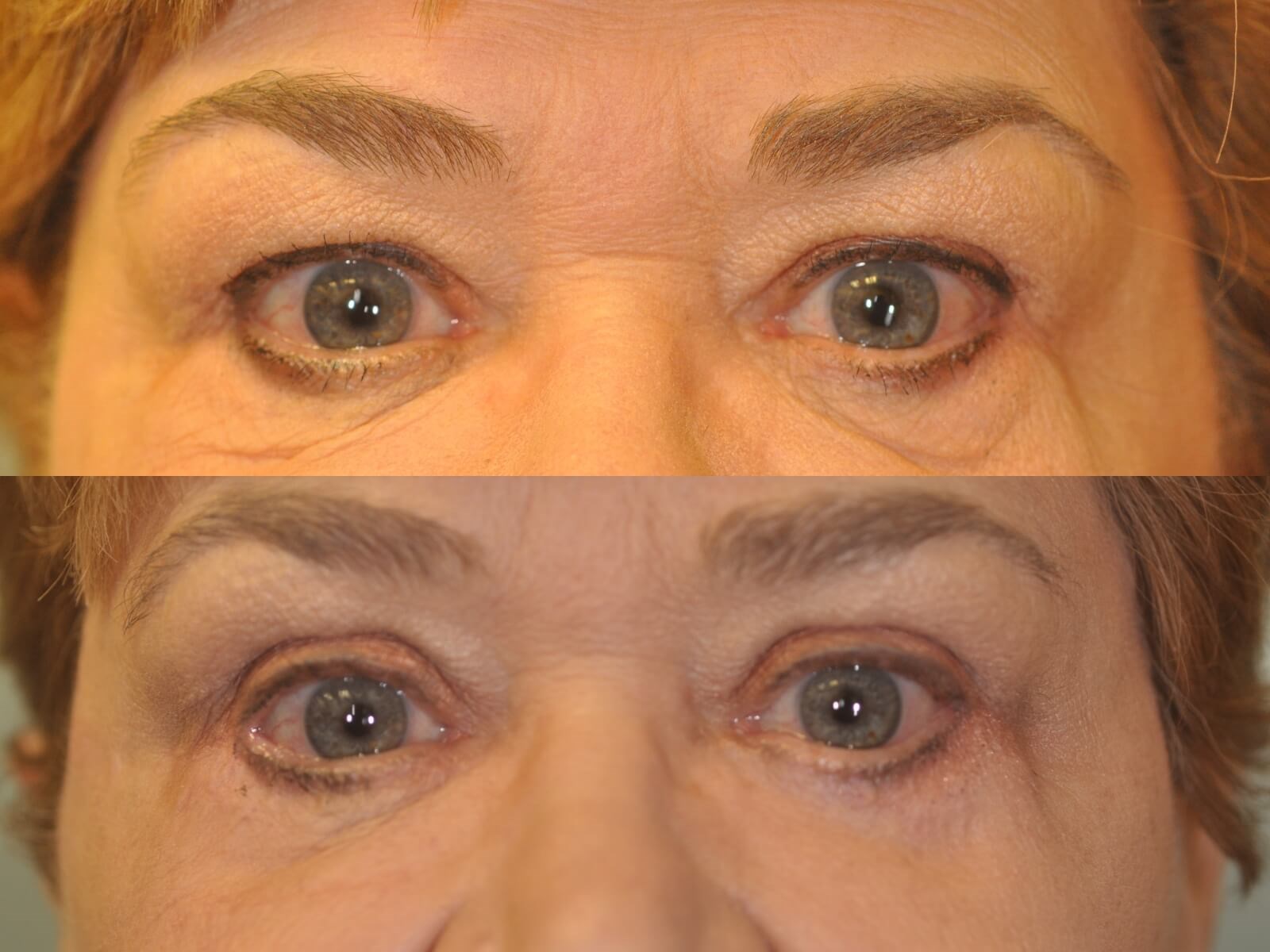 A more youthful look  Before and After