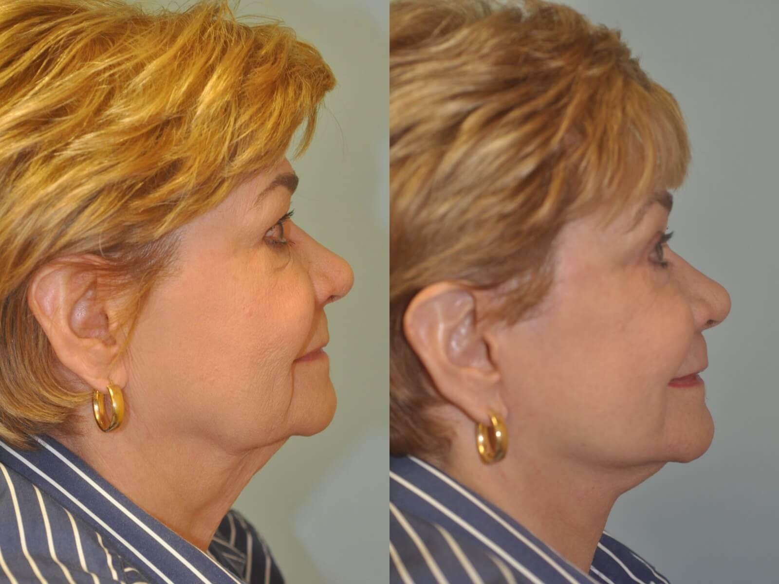 Smooth jawline Before and After