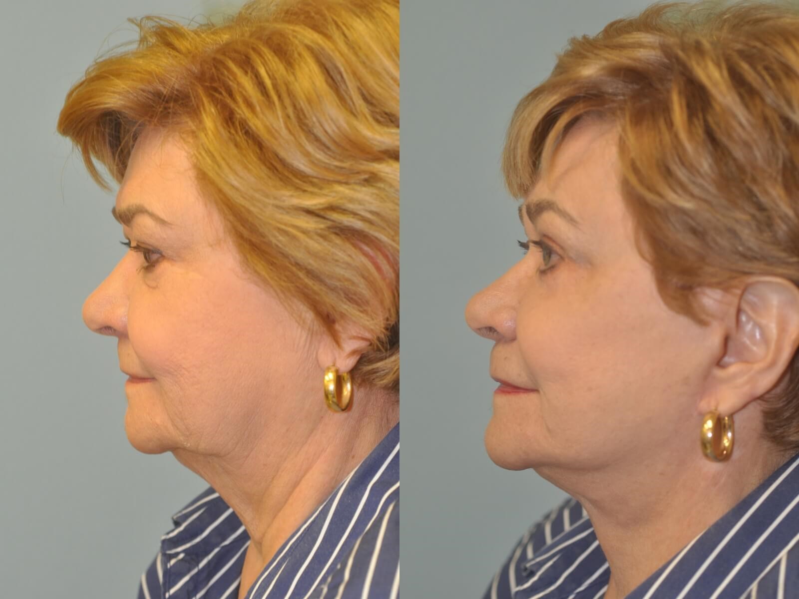 Smooth jawline Before and After