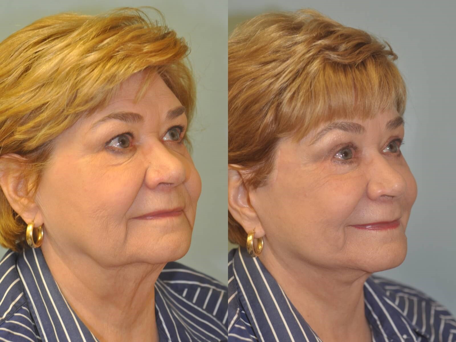 No more jowling! Before and After