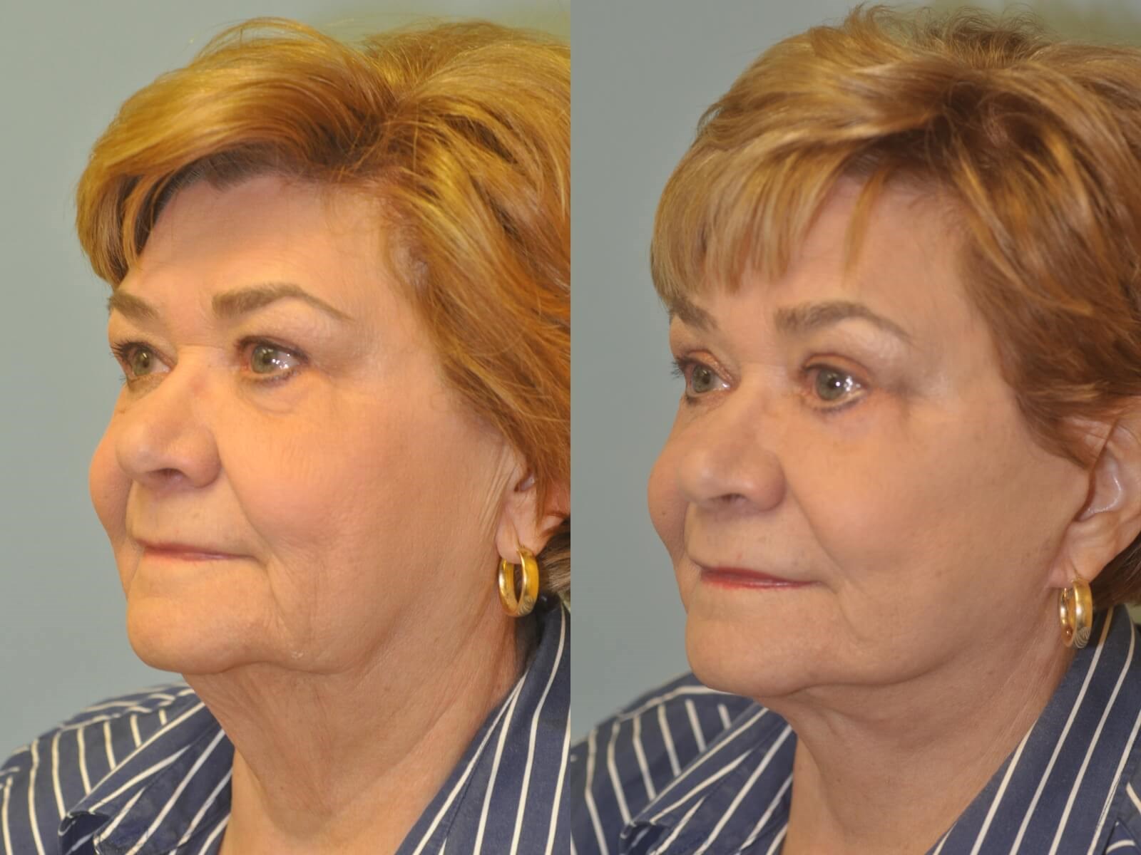 No more jowling! Before and After