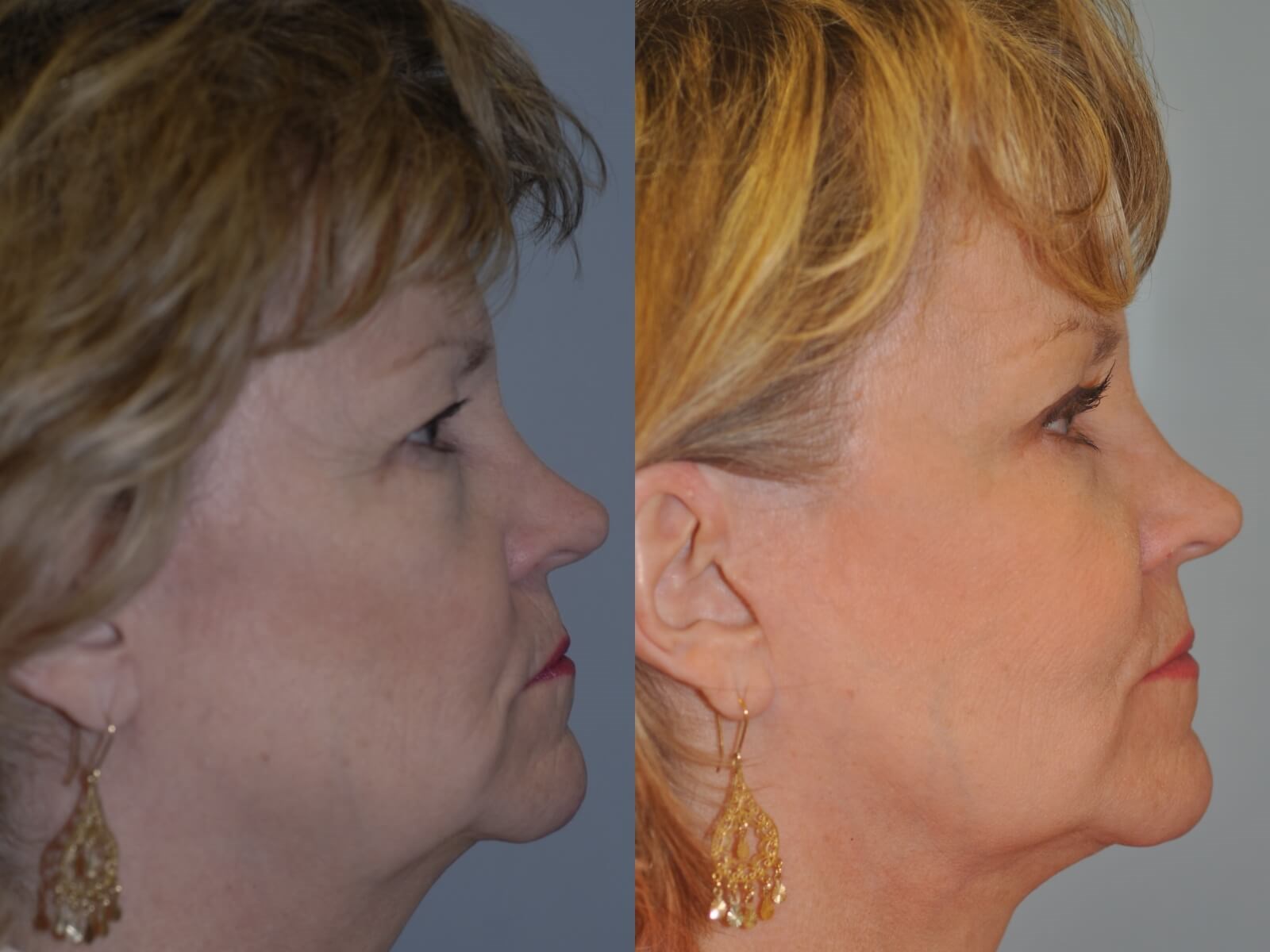A new jawline Before and After