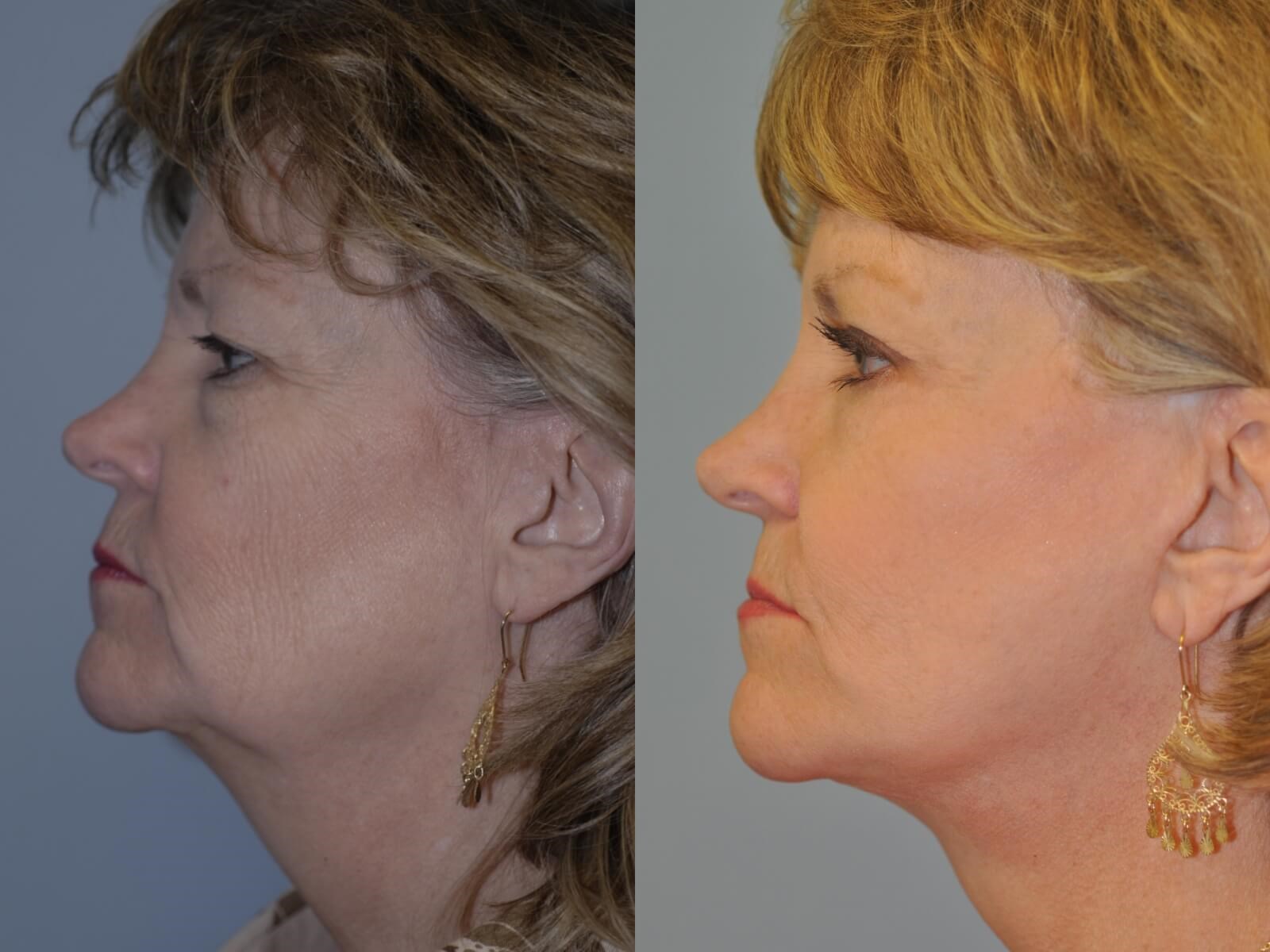 A new jawline Before and After