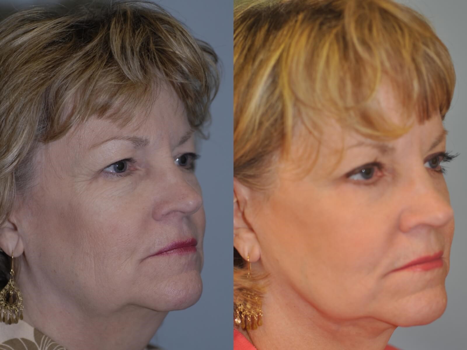 Looking 20yrs younger! Before and After