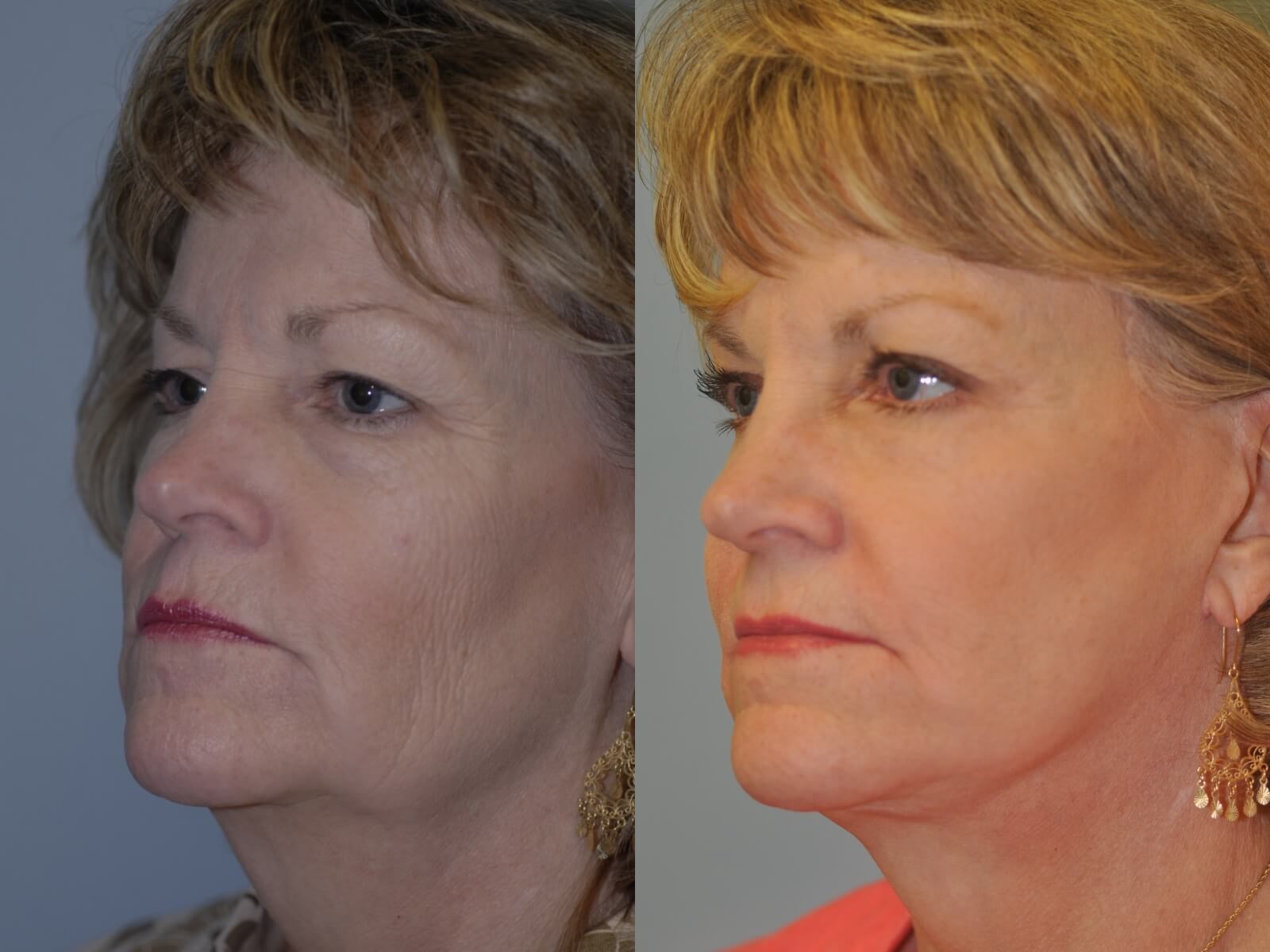 Looking 20yrs younger! Before and After