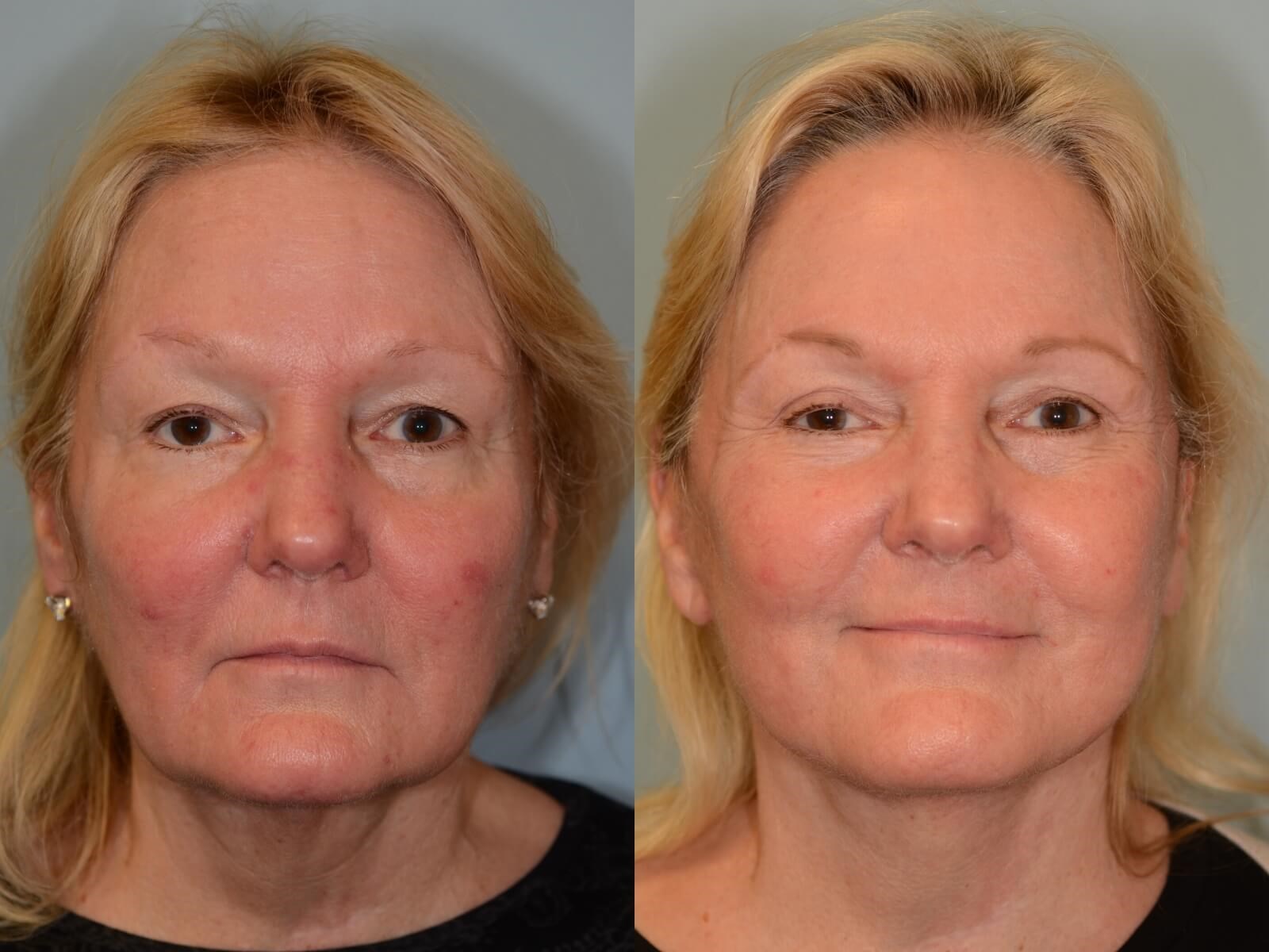 Rejuvenated Facial Features Before and After