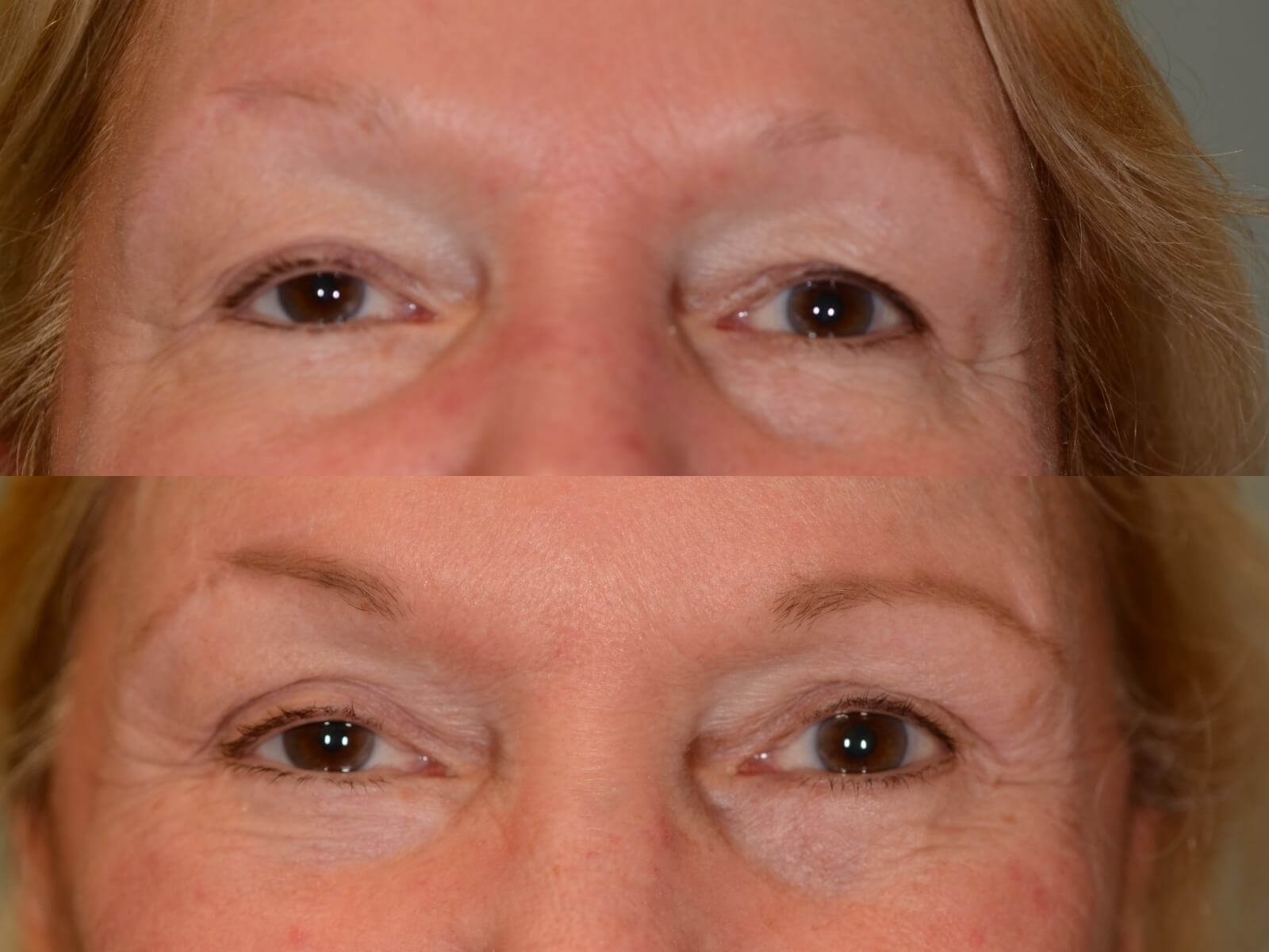 Rejuvenated Facial Features Before and After