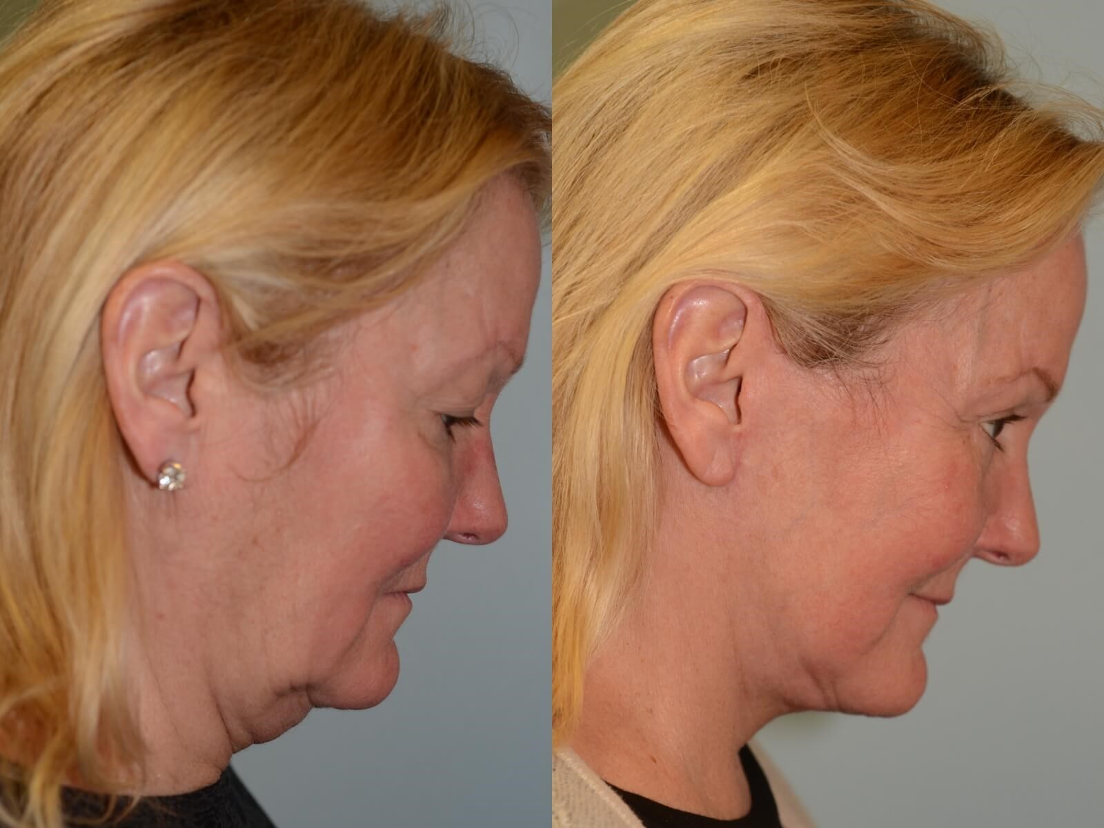 No more redundant skin Before and After