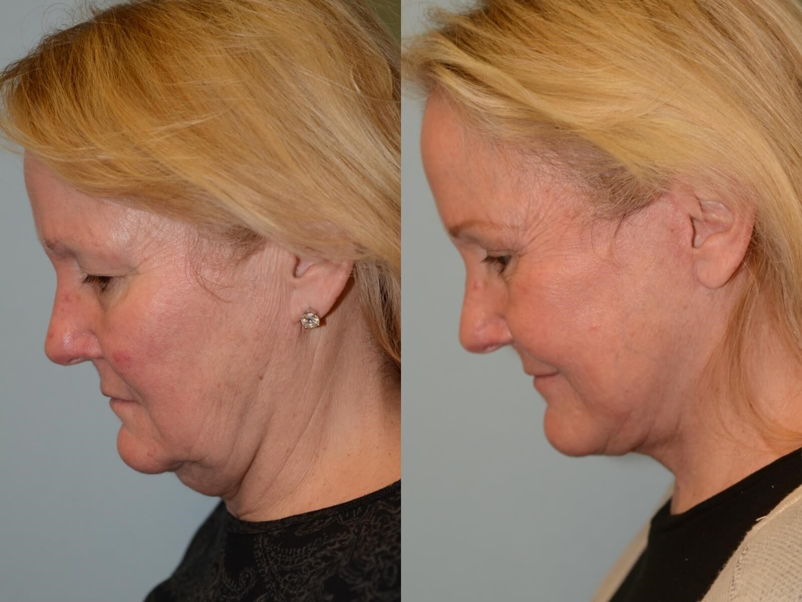 No more redundant skin Before and After