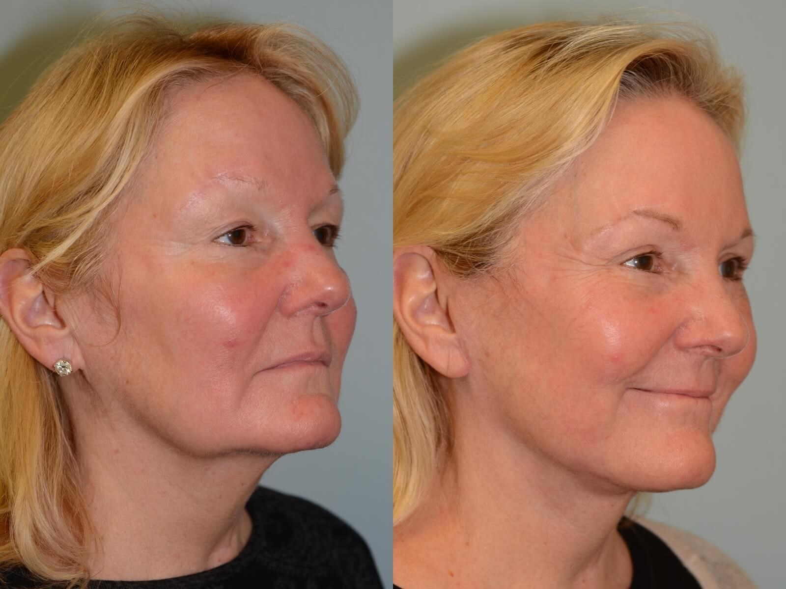 Smooth and youthful lines Before and After