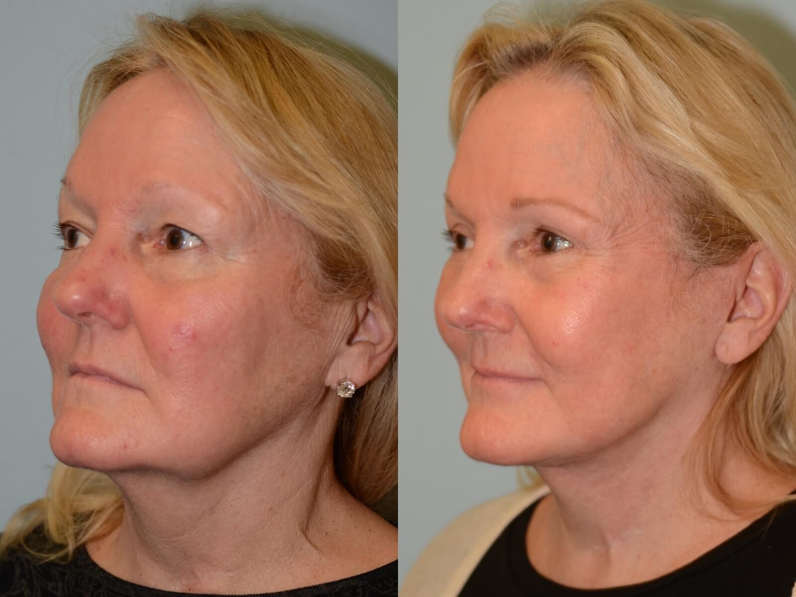 Smooth and youthful lines Before and After