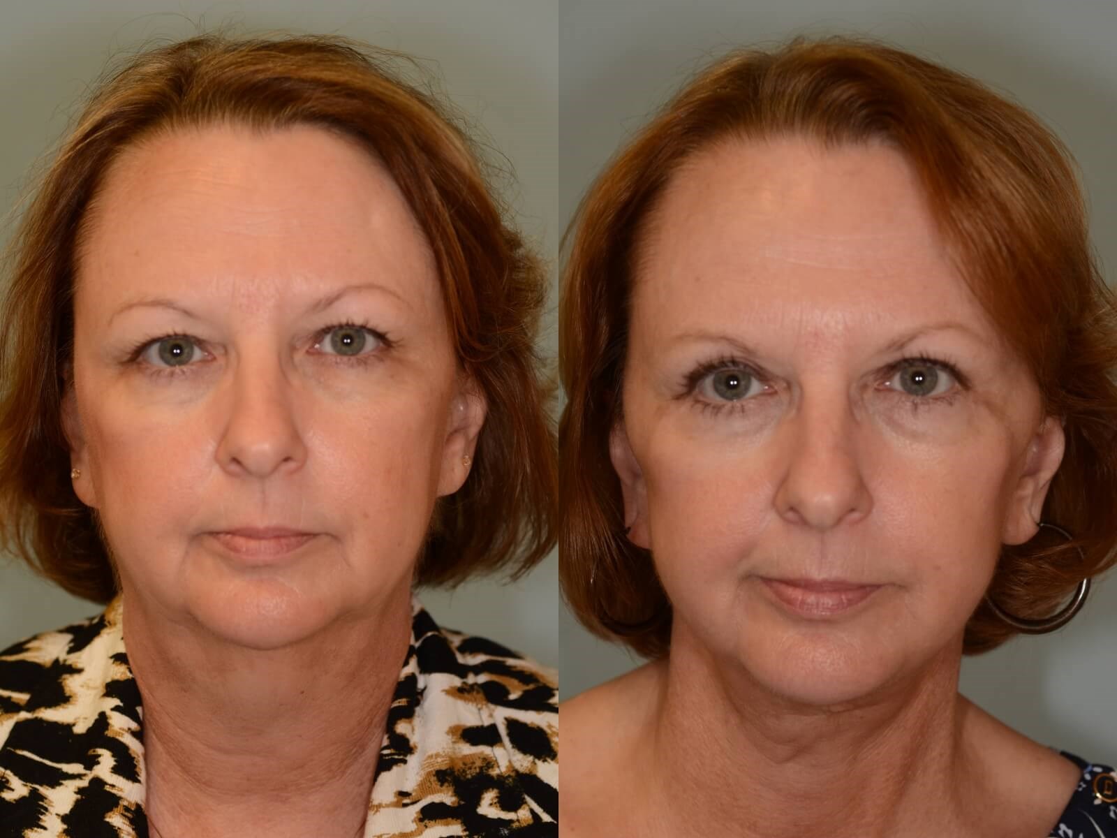 Facelift, Neck lift Before and After
