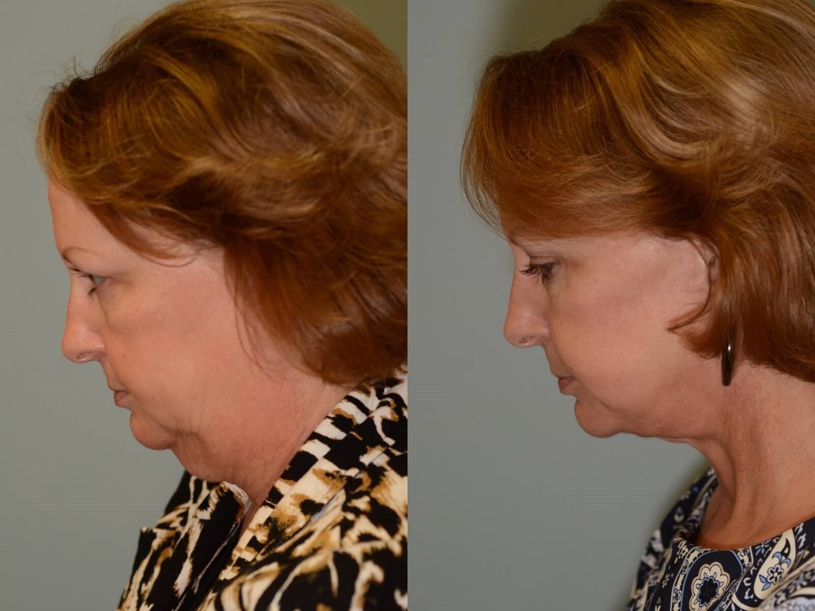 Facelift, Neck Lift Before and After