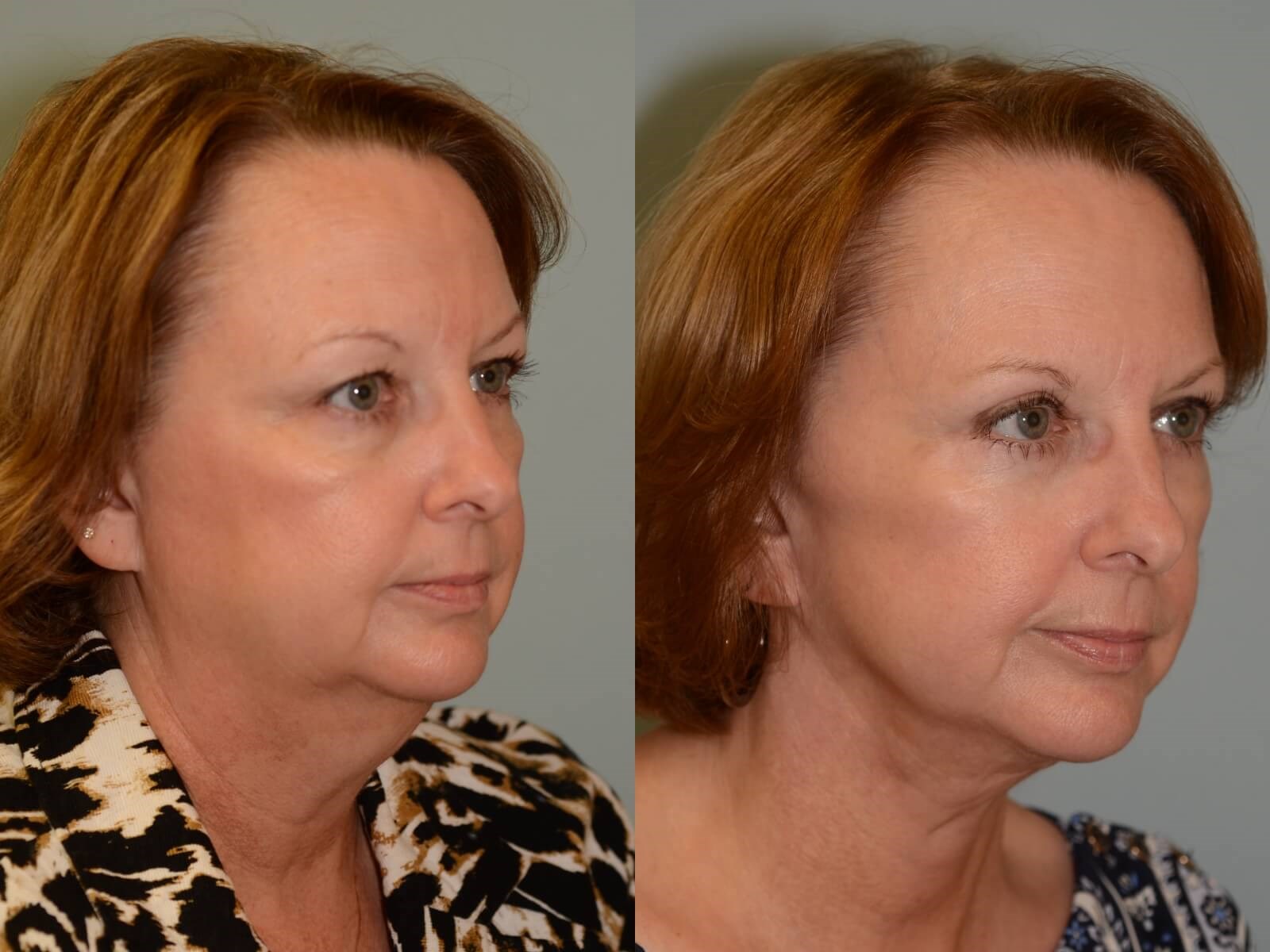 Facelift, Neck Lift Before and After