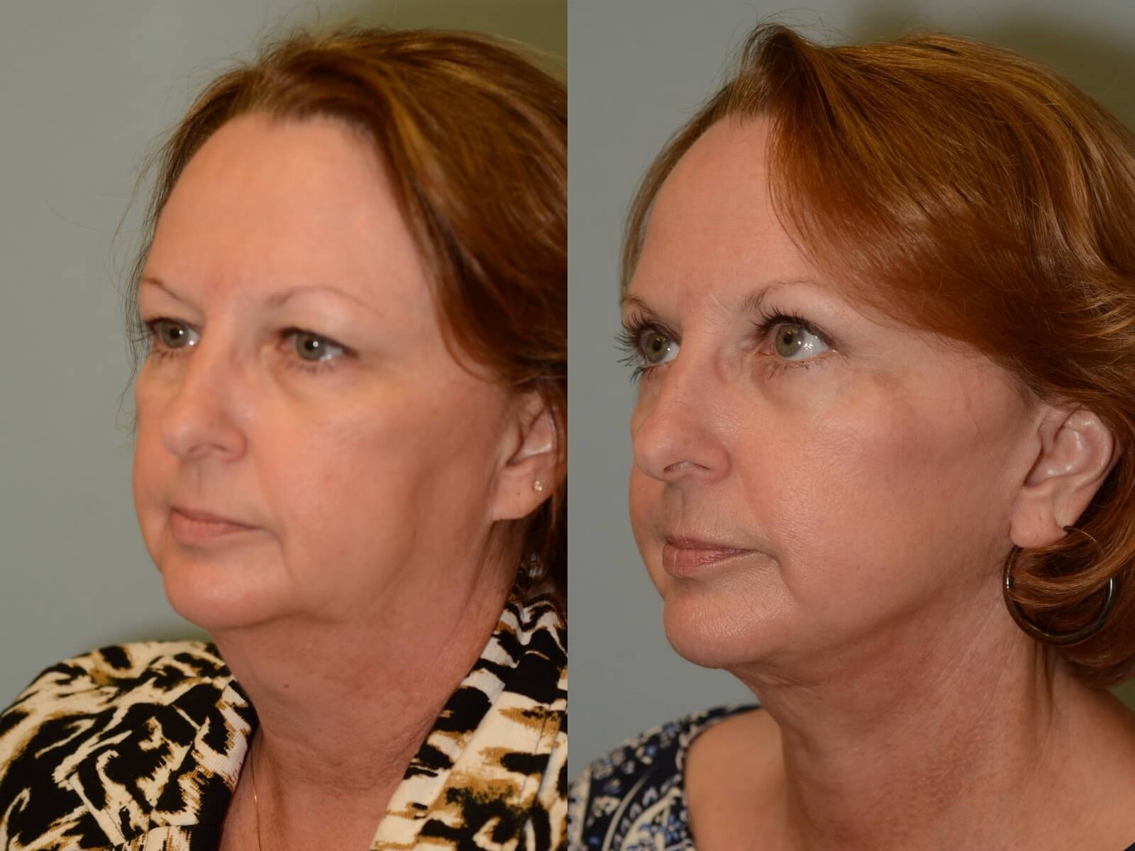 Facelift, Neck Lift Before and After