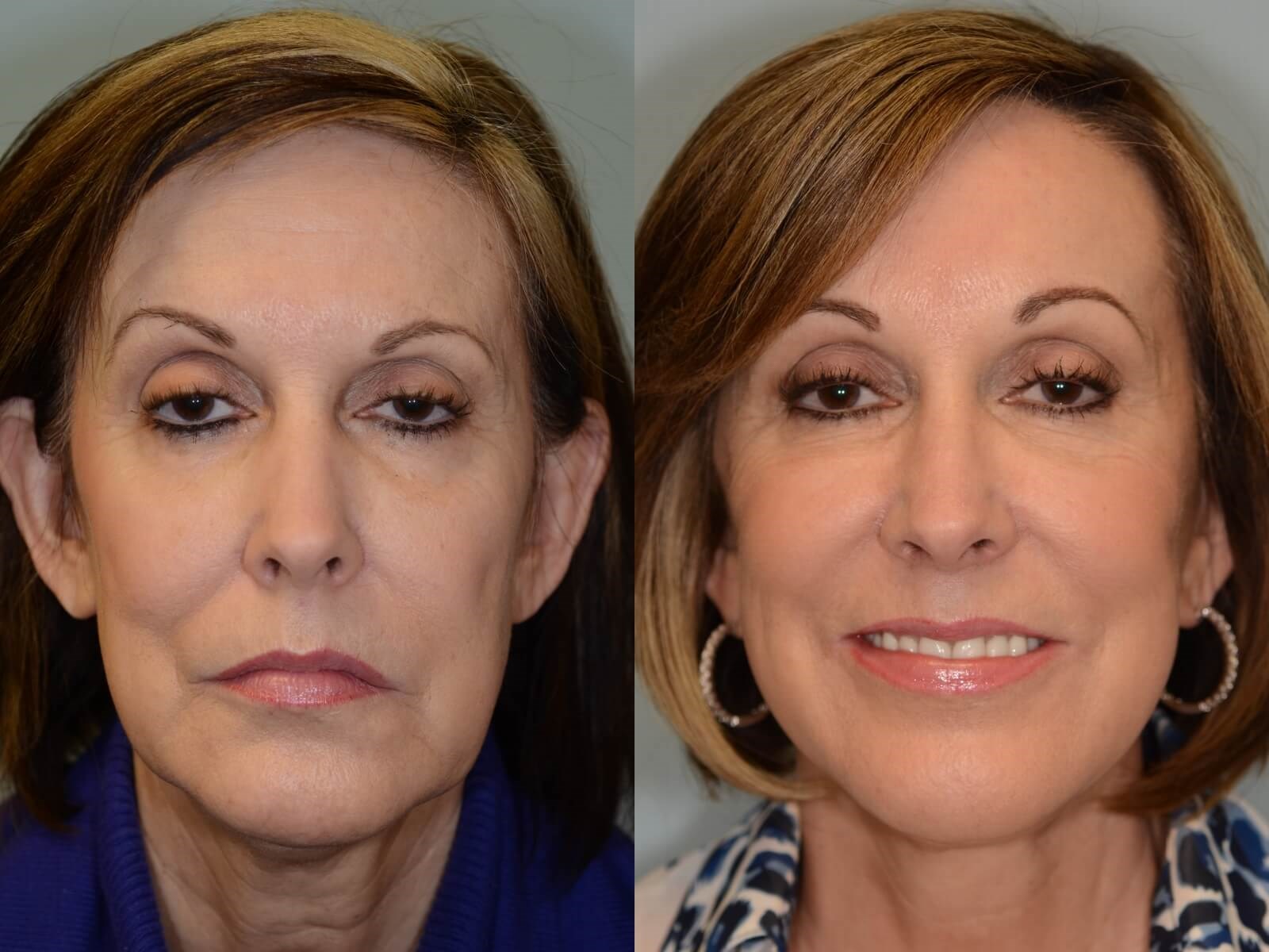 Facelift Before and After