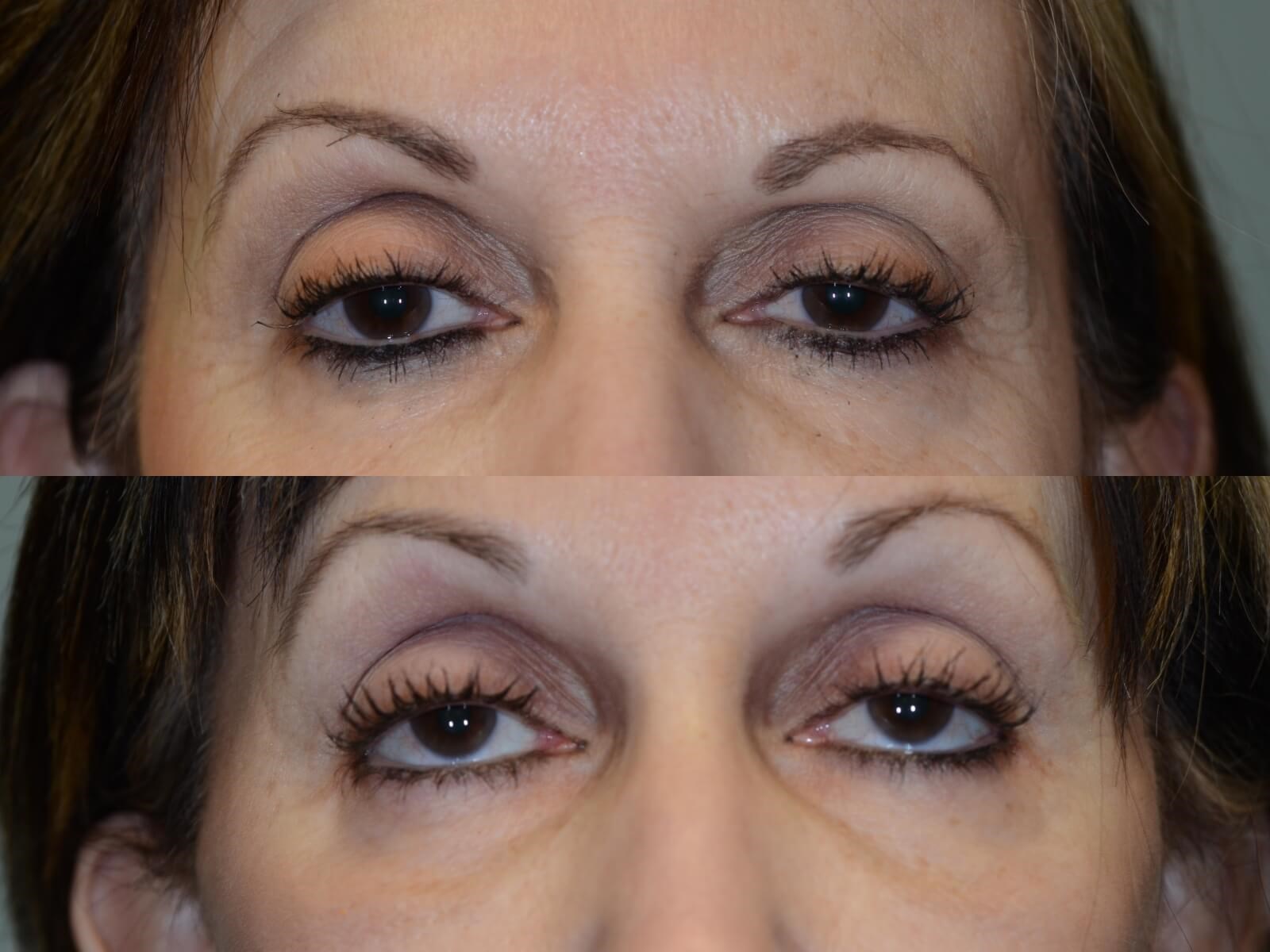 Facelift Before and After