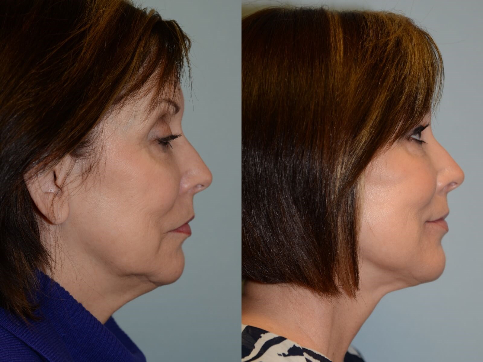 Looking more refreshed! Before and After