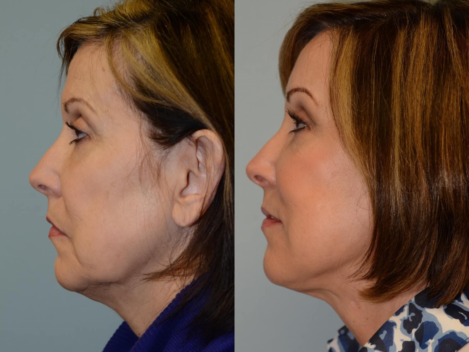 Looking more refreshed! Before and After