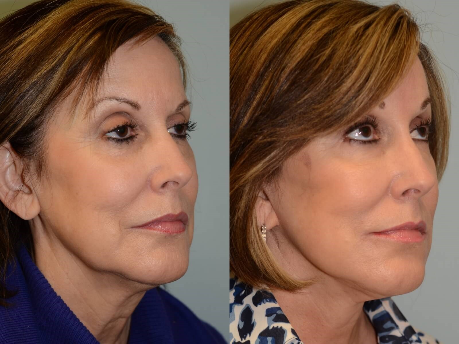 Smooth uplifting lines Before and After