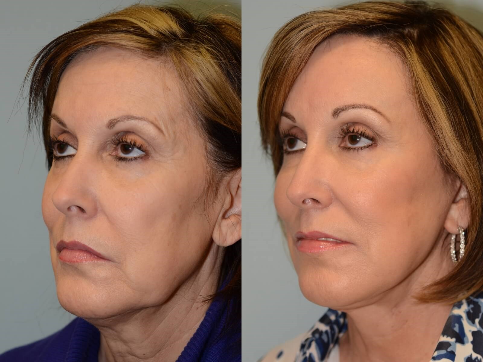 Smooth uplifting lines Before and After