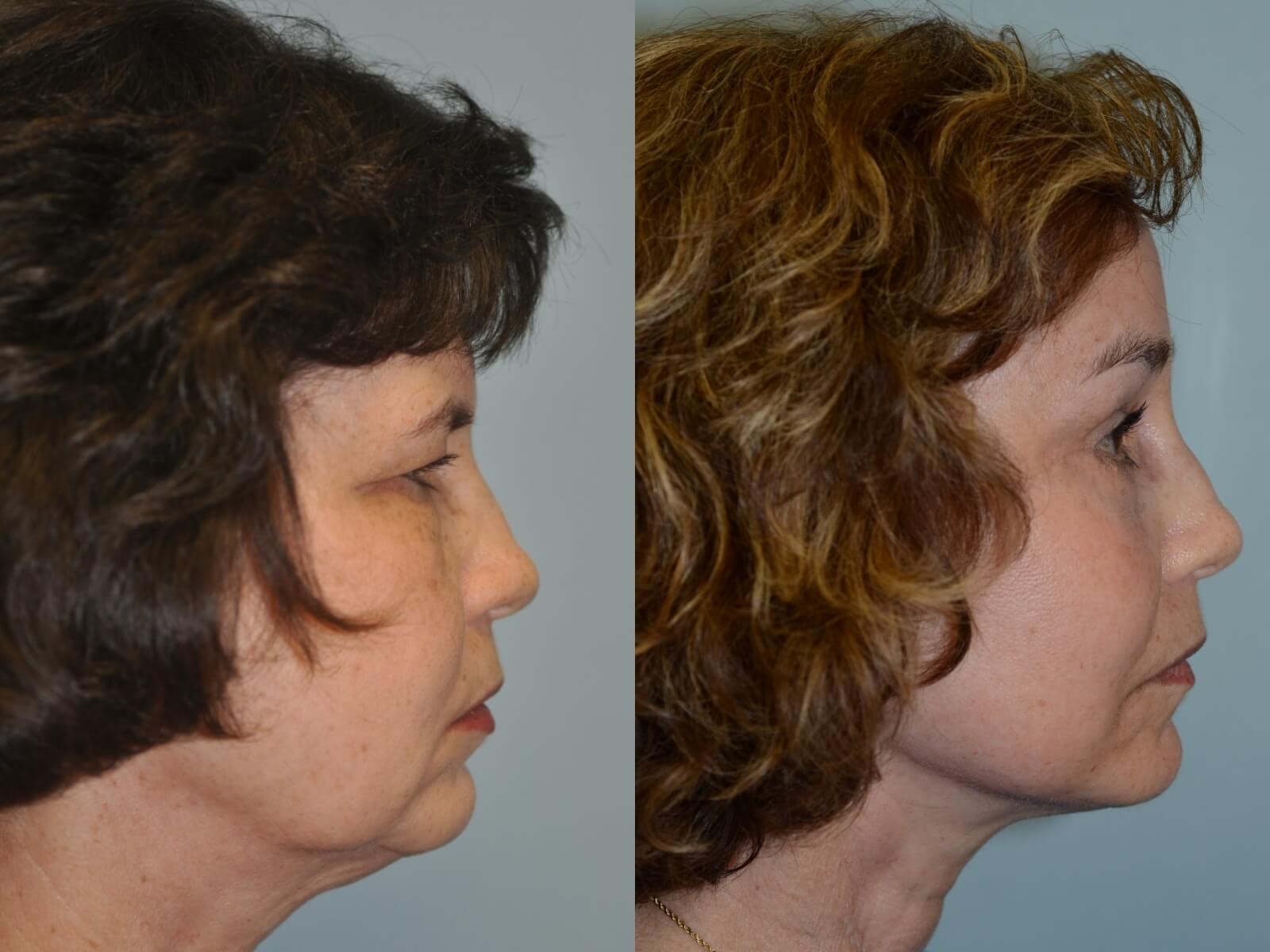 A smooth jaw and neck contour Before and After