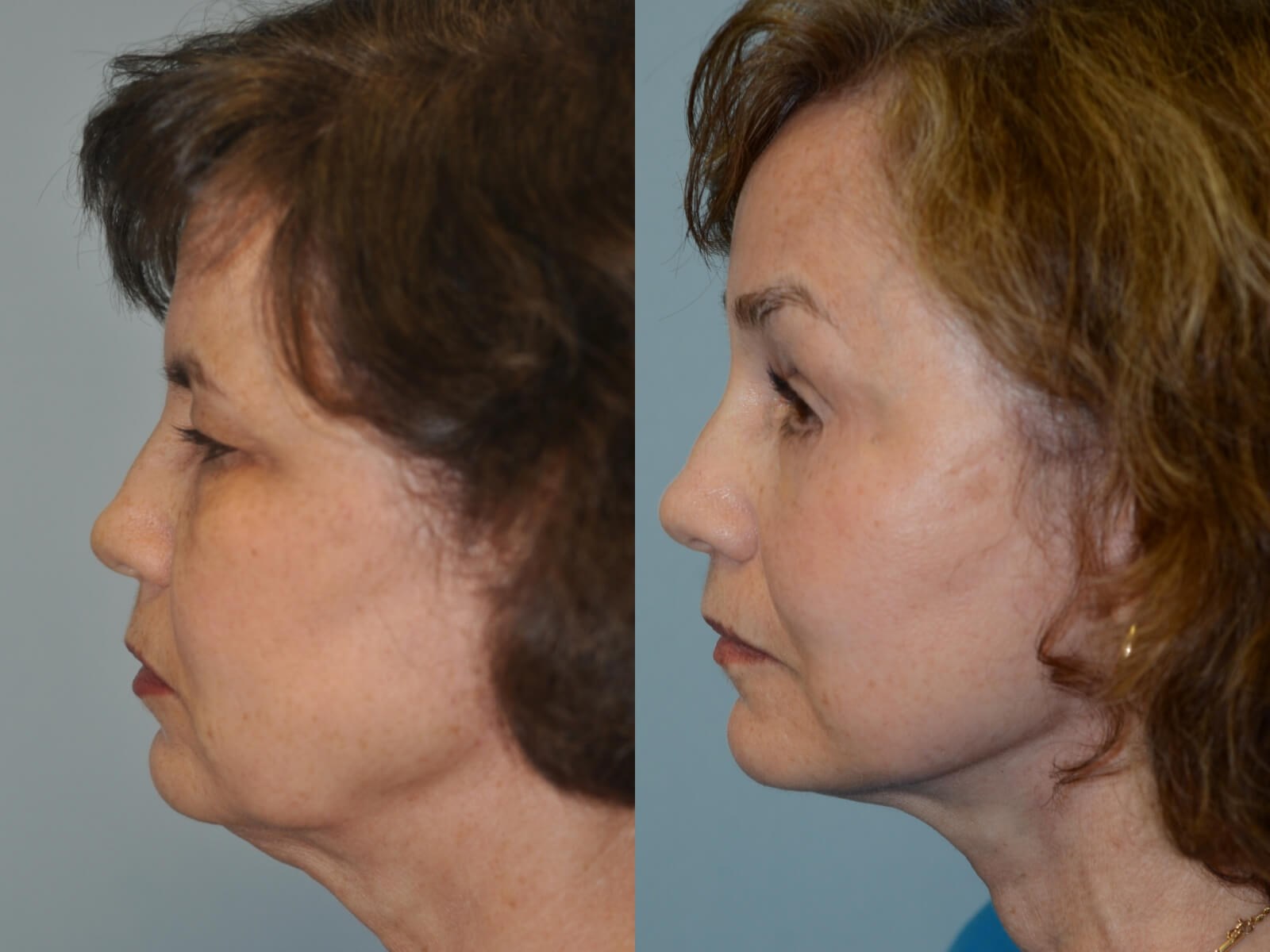 A smooth jaw and neck contour Before and After