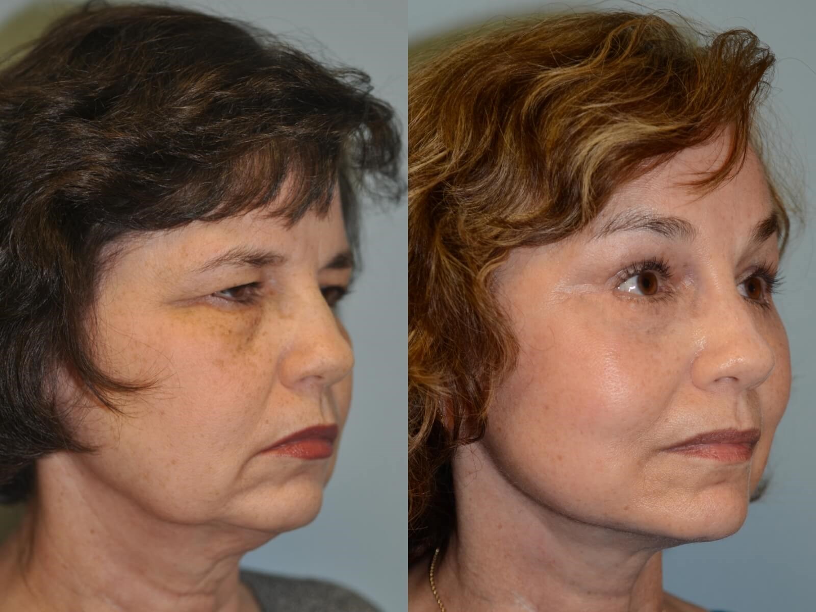Refreshed and Rejuvenated Before and After