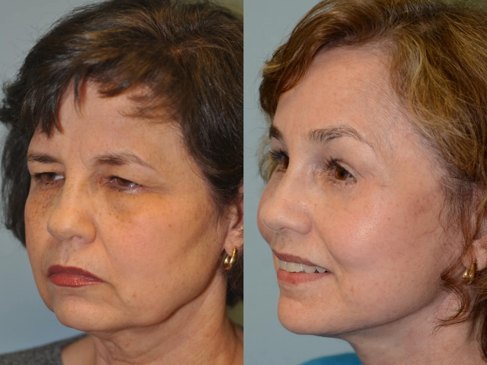 Refreshed and Rejuvenated Before and After
