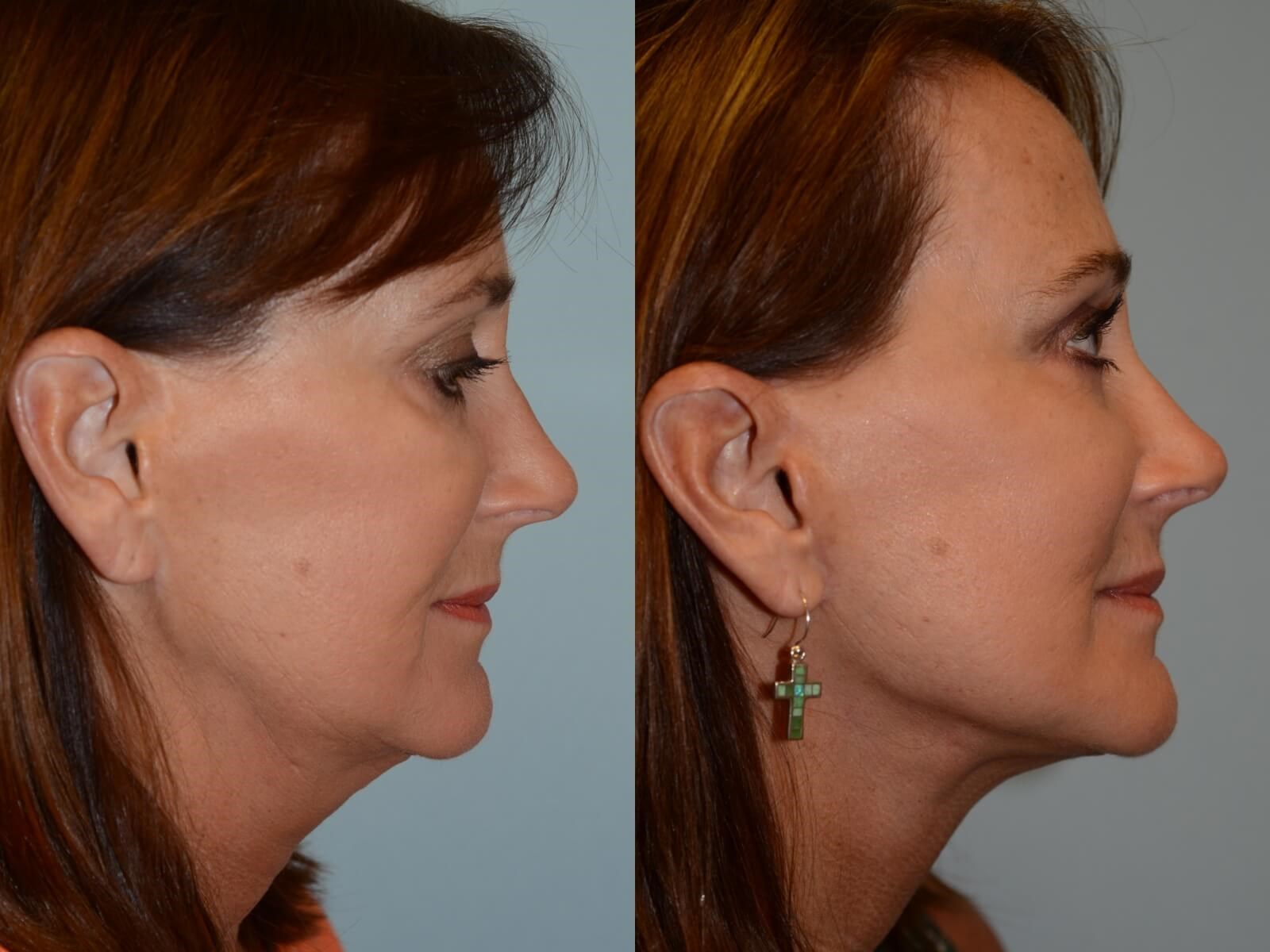 A more defined jaw line Before and After