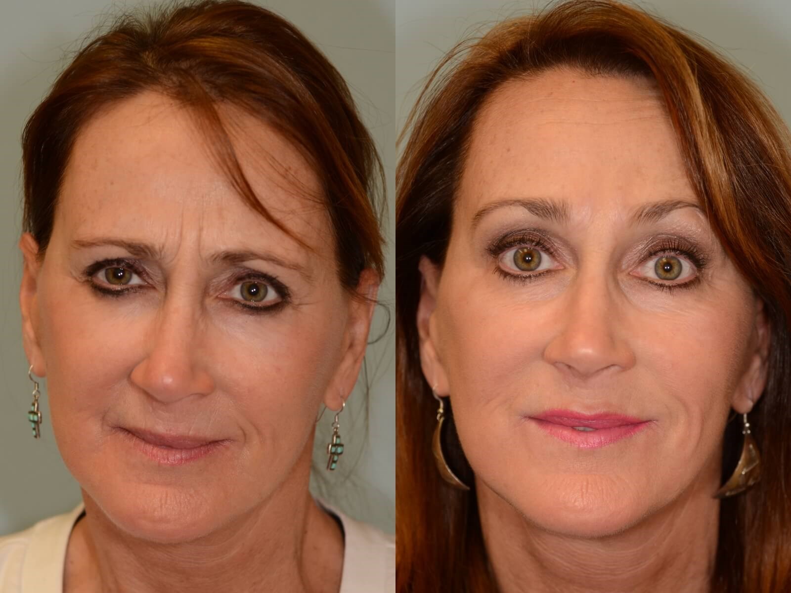 Facelift and Neck Lift Before and After