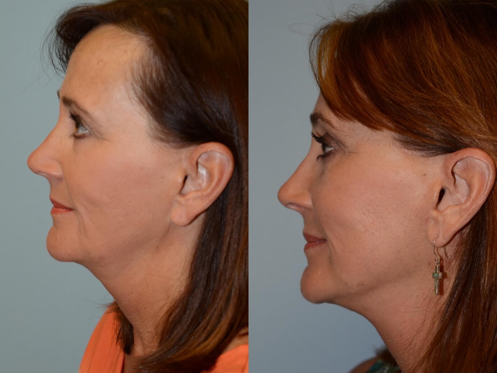 A more defined jaw line Before and After