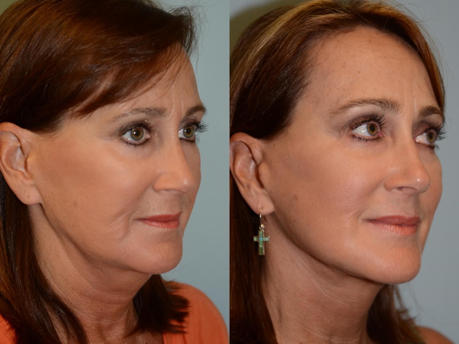 No more jowling! Before and After
