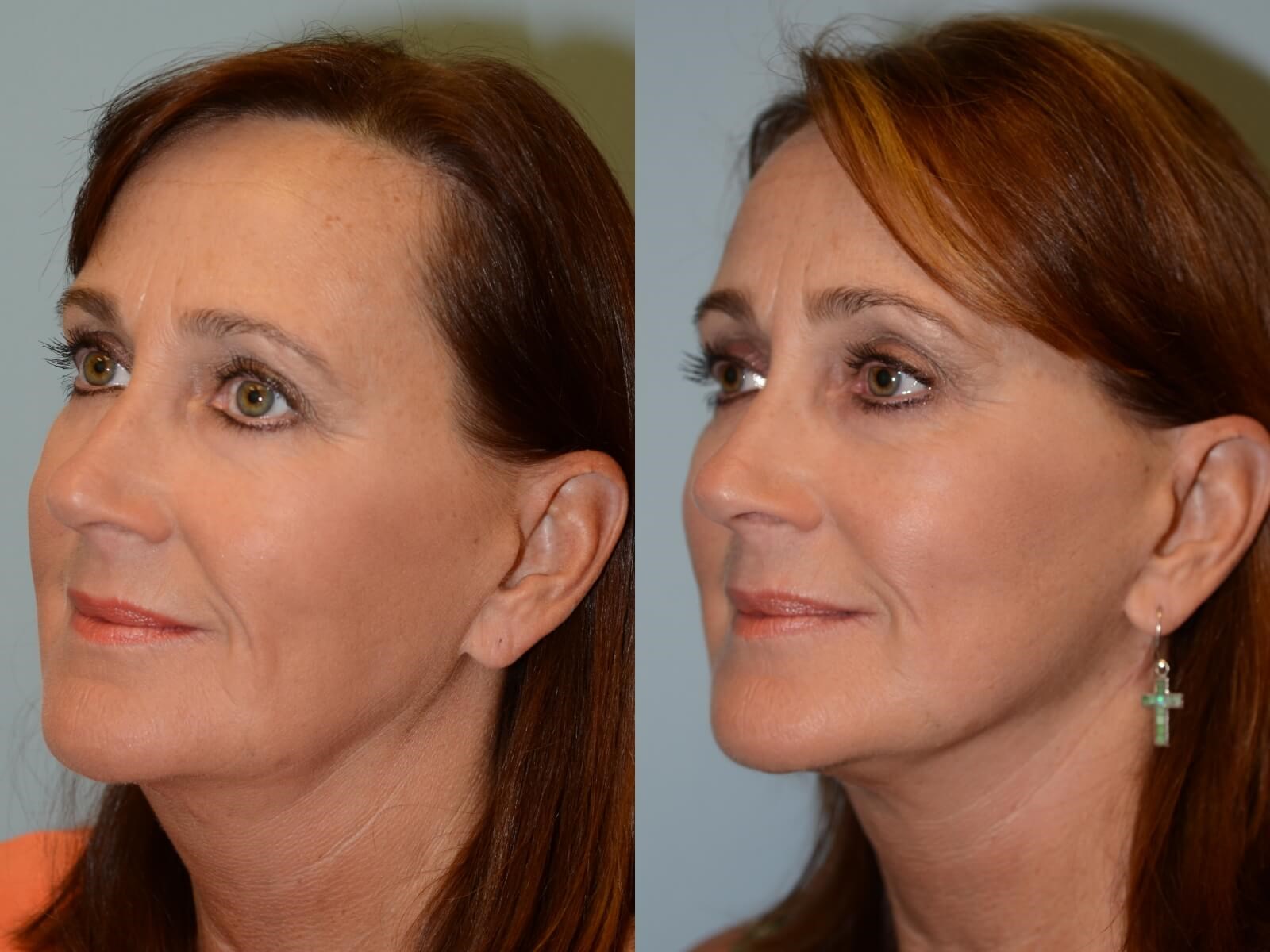 No more jowling! Before and After