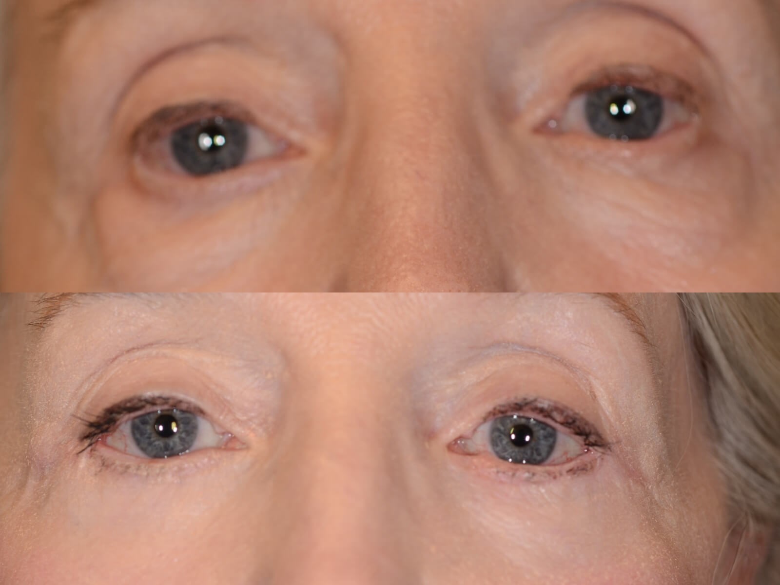 Vibrant eyes Before and After