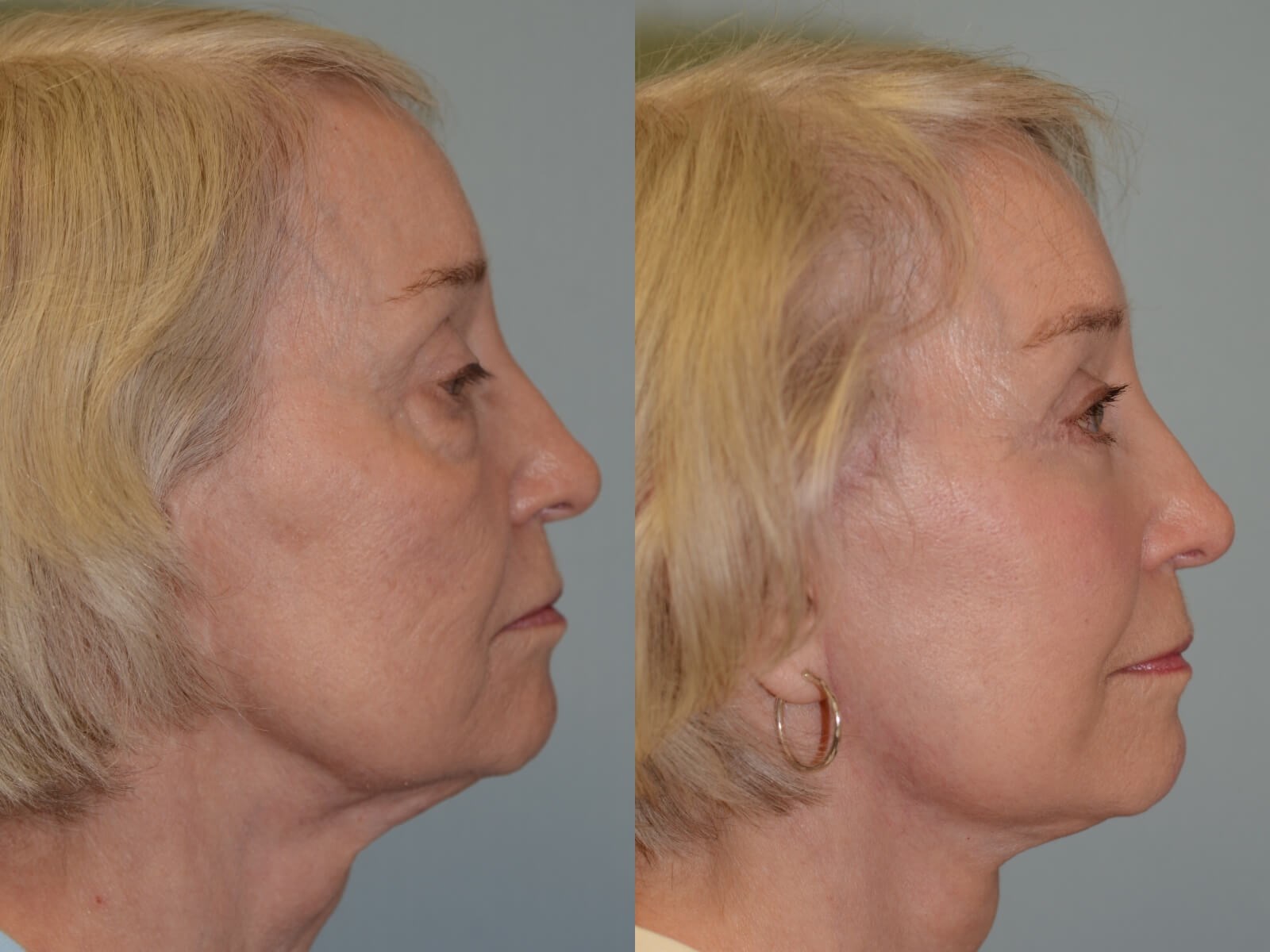 No more loose skin Before and After