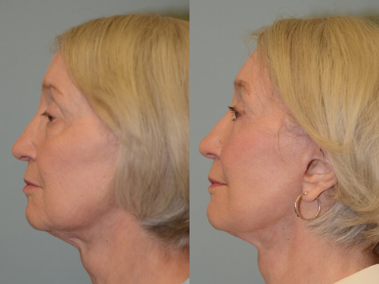 No more loose skin Before and After