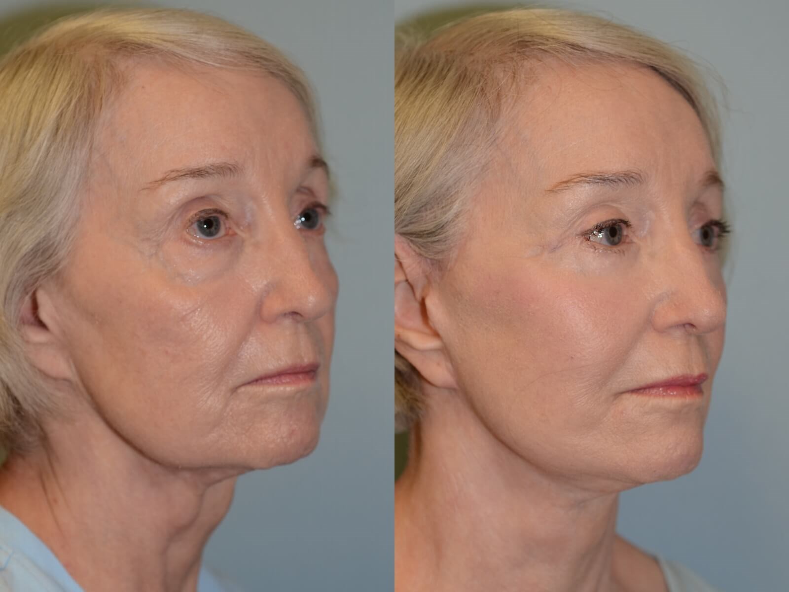 Rejuvenated Facial Features Before and After