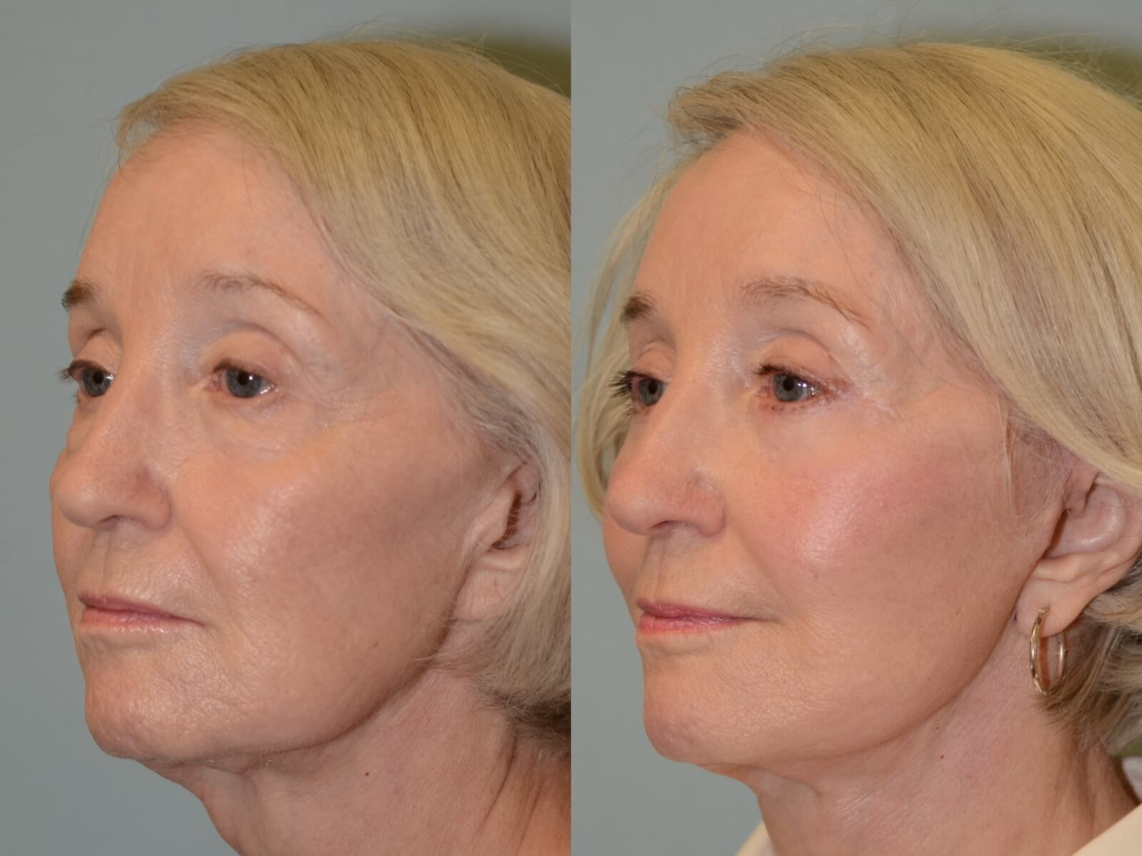 Rejuvenated Facial Features Before and After