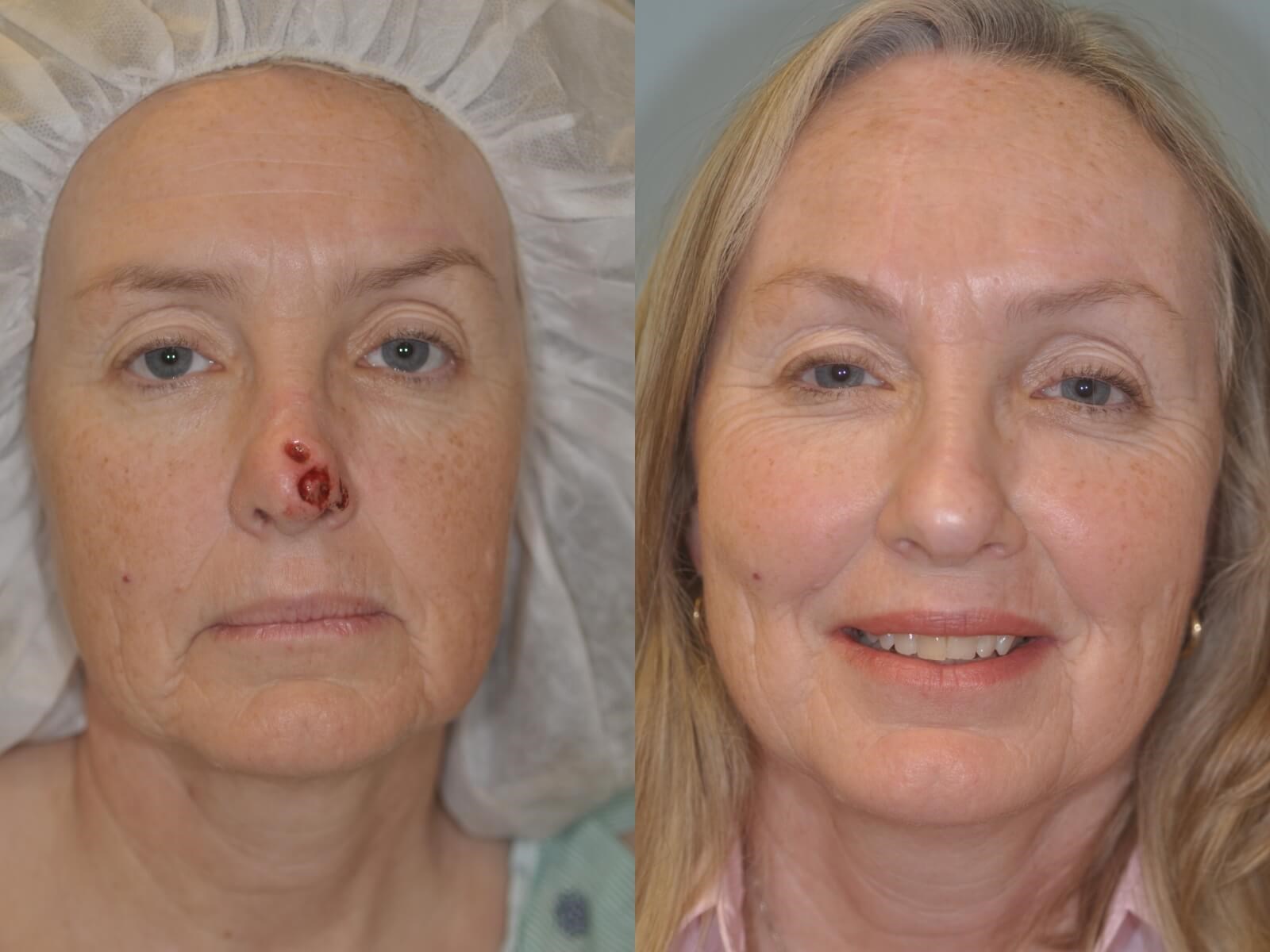 MOHS reconstruction with Forehead Flap MOHS reconstruction with Forehead Flap