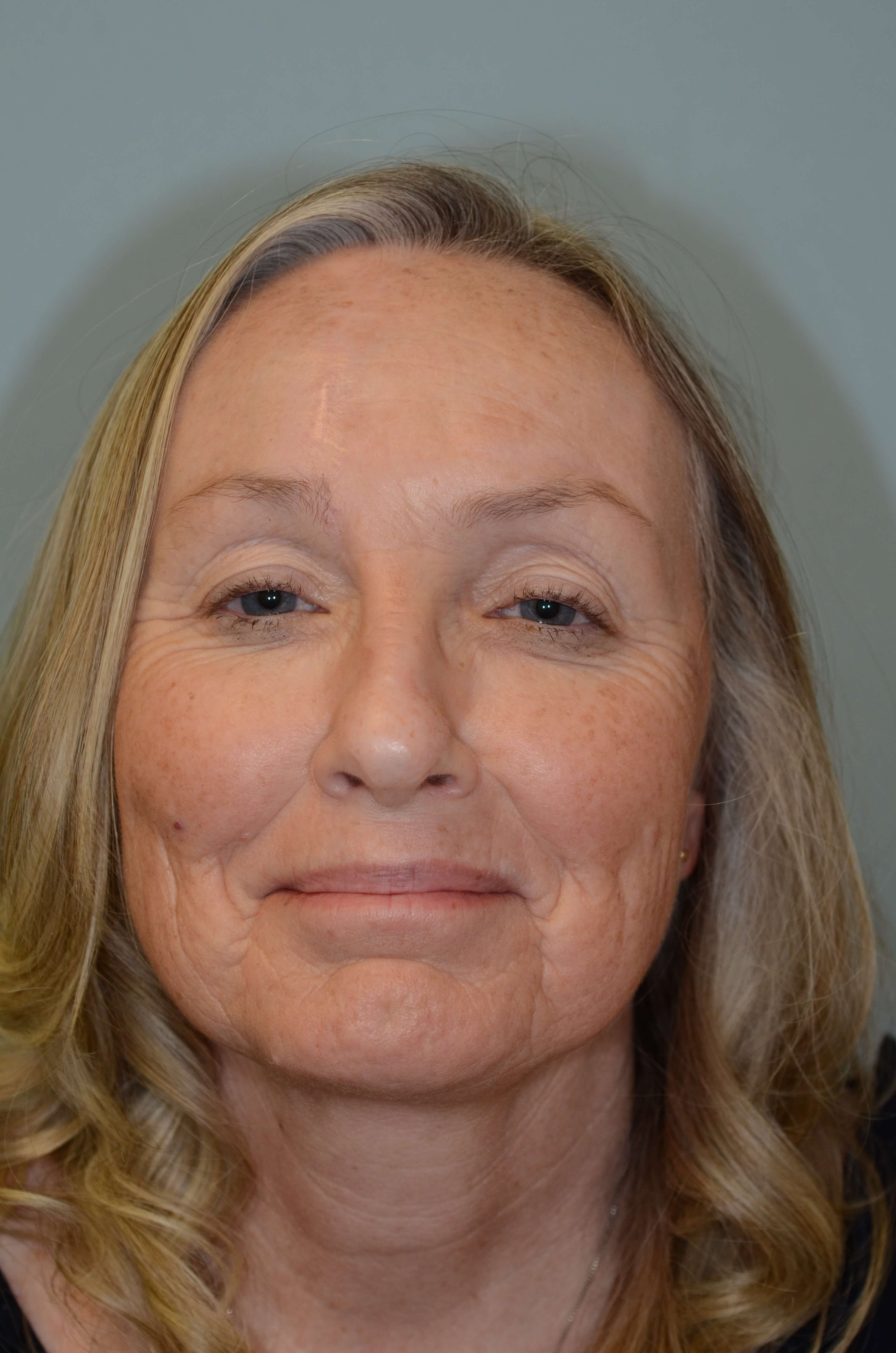 2 and 5 years post FHF sugery 2 years after surgery