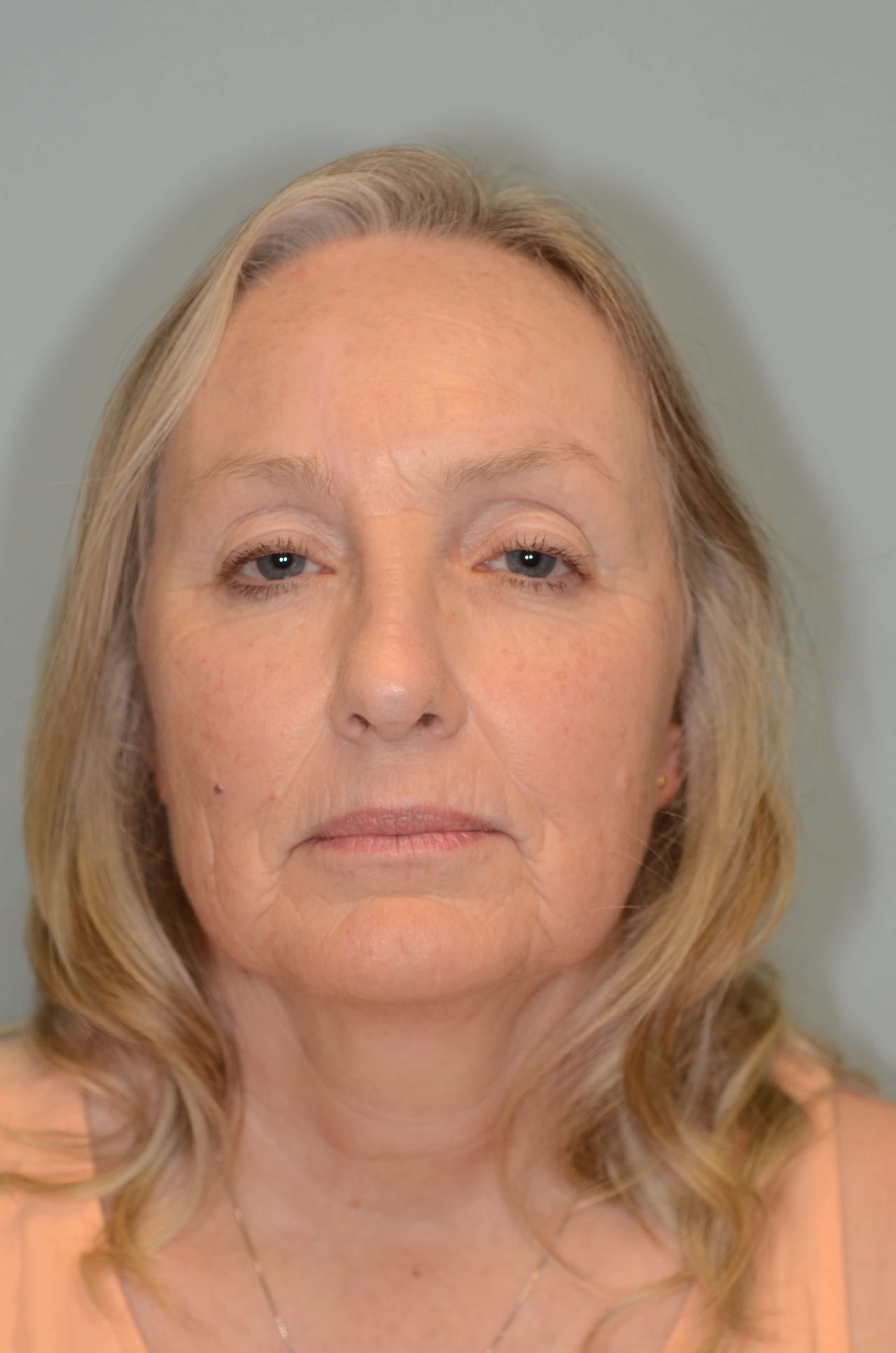 2 and 5 years post FHF sugery 5 years after surgery
