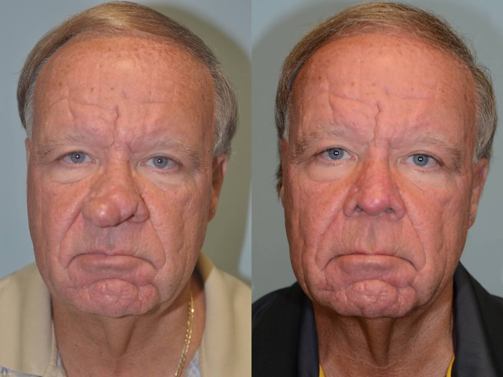 Nasal Reconstruction by Excision of Rhinophyma